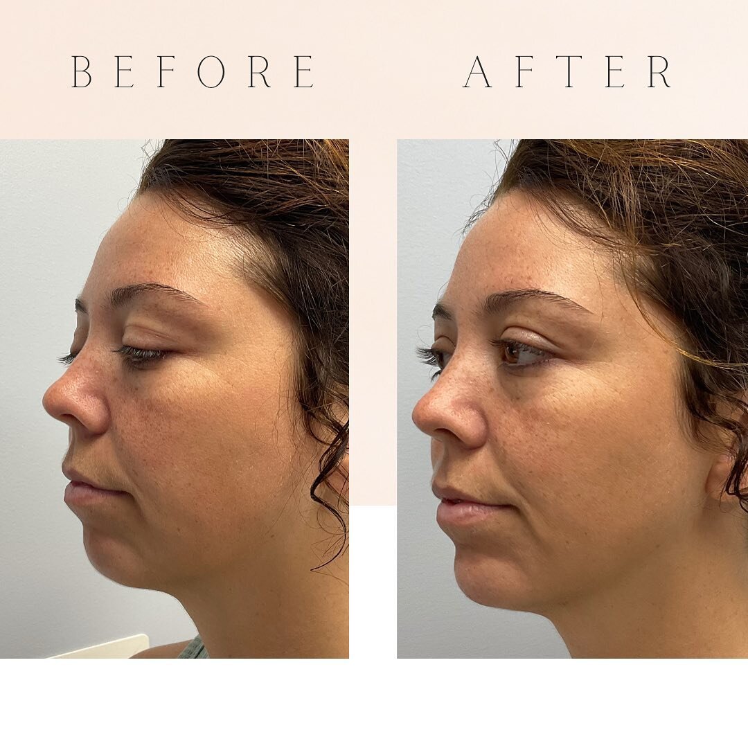 Chin filler, often an overlooked treatment option, holds the power to reshape facial contours in a profound way. Through subtle adjustments to the chin's proportions, it in turn enhances the jawline, creating a transformation that significantly yet s