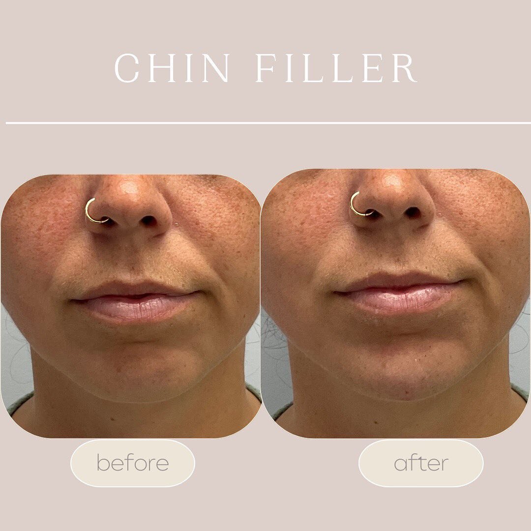 Enhancing facial contours with chin filler 🌟 Subtly projecting and elongating the chin resulted in the transition of a more feminine heart-shaped face, while simultaneously accentuating a more defined jawline!