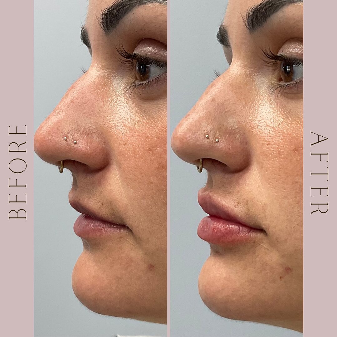 After multiple lip flips, this beautiful client decided it was time for lip filler! What she didn&rsquo;t expect, was that a slight enhancement in lip volume balanced out her natural prominent chin for a more elegant profile! 😍