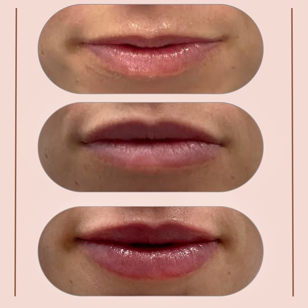 This client&rsquo;s results were not achieved in a single session. When working with thinner lips, it's crucial to avoid overfilling and instead gradually sculpt the perfect pout.