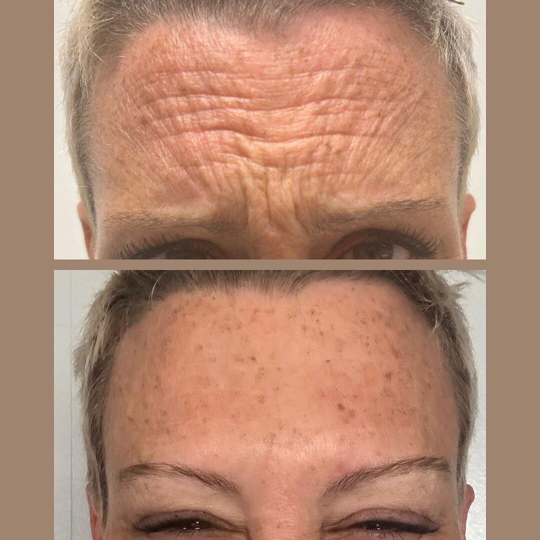 This client, with strong frontalis and glabellar muscles, received Dysport to these areas along with a brow lift! The result? A dramatic, yet natural appearing glow that beautifully defies the signs of aging✨