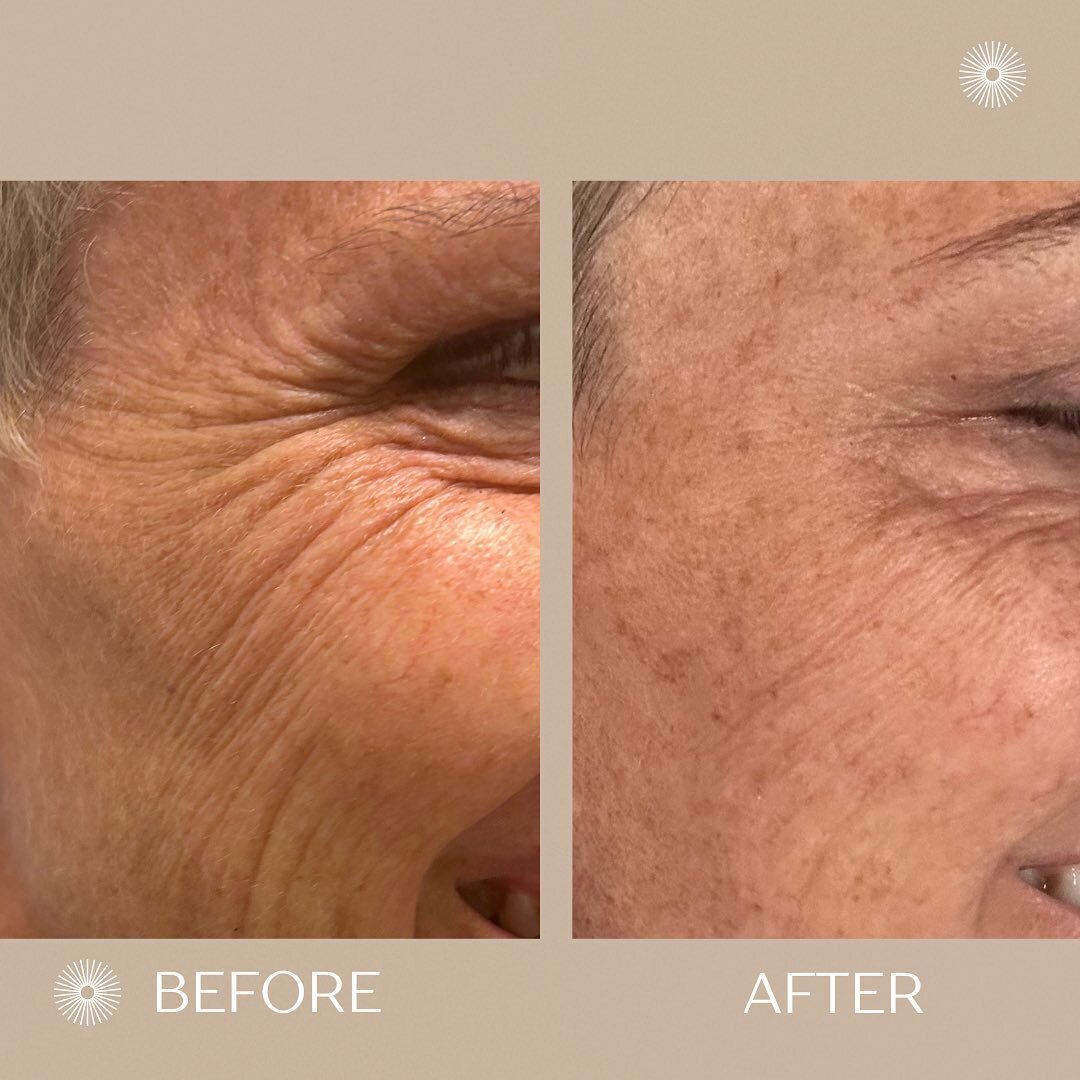 What are crows feet? They're those fine lines that start to show up at the outer corners of our eyes and gradually deepen and become more noticeable in time. Tox is an easy treatment option to help lessen the appearance of these lines! Typical dosing