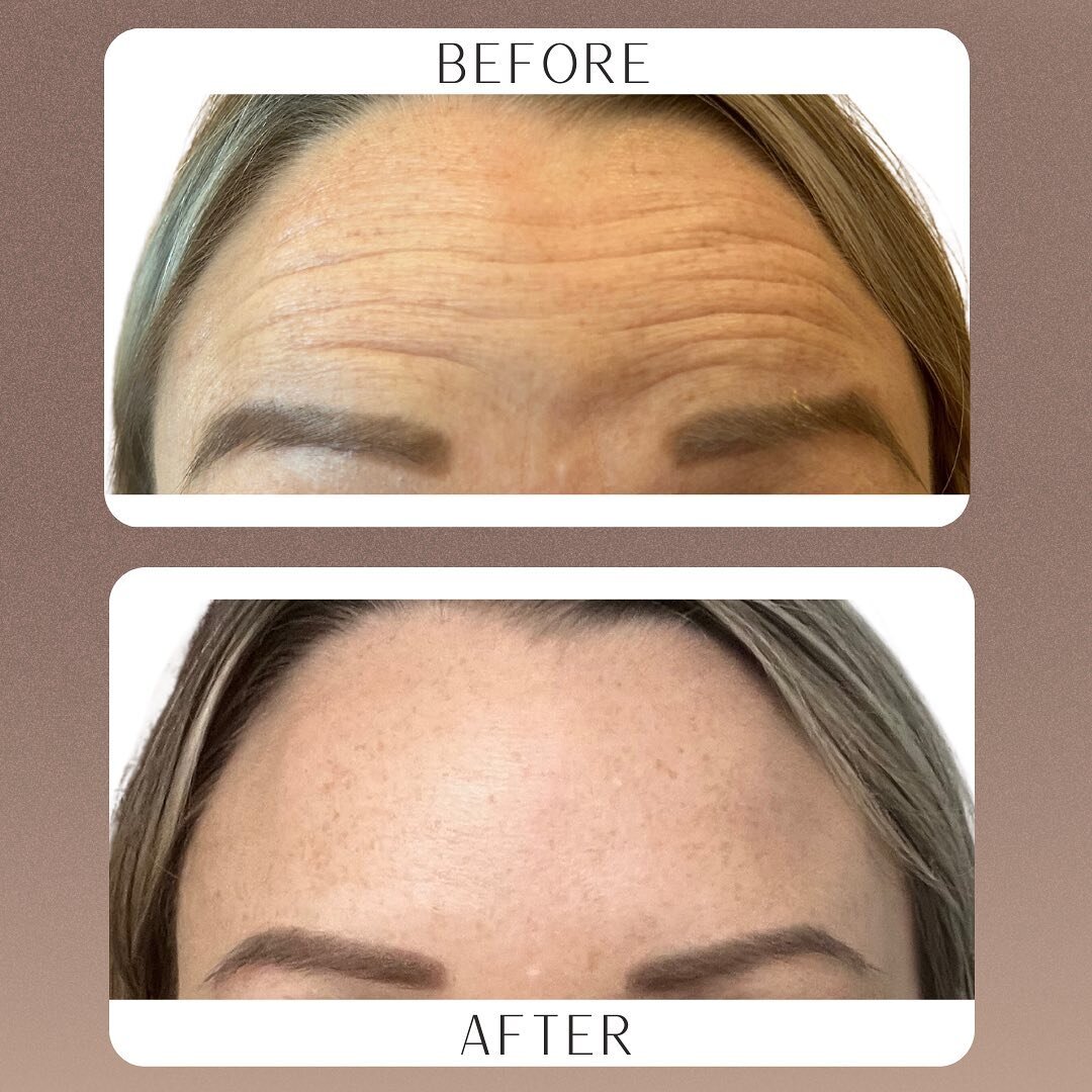 Meet one of my supermom clients who has mastered the art of balancing motherhood and self-care, with a little help from tox! 🤫💉 

.

.

.

#TimelessBeauty #Botox #Jeauvea #Dysport #MedSpa #BeforeAfter #GlowUp #GoodbyeWrinkles #MomSelfCare #BotoxSup