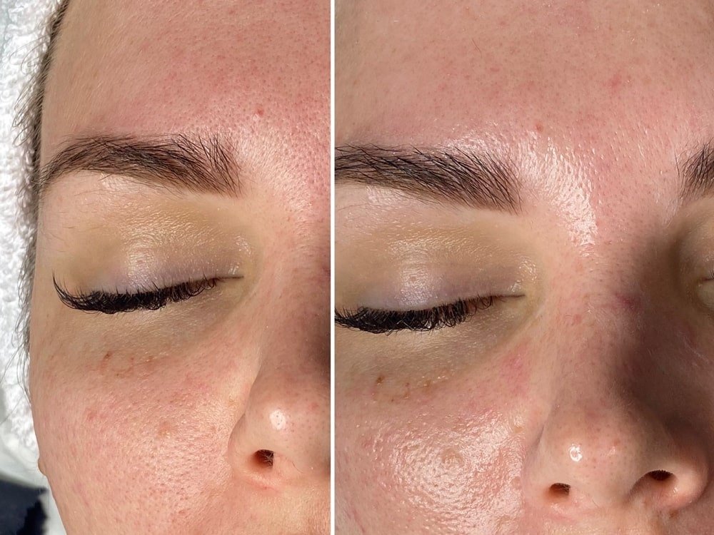 dermaplane-b&a.jpg