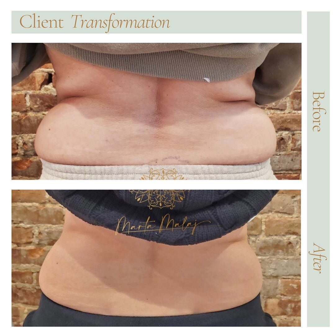✨BEFORE AND AFTER✨

Lipolysis injections can be a good choice for people who are at or close to their ideal weight but have one or more bod areas where they would like to remove persistent fat 'pockets'. The treatment is especially useful for abdomen