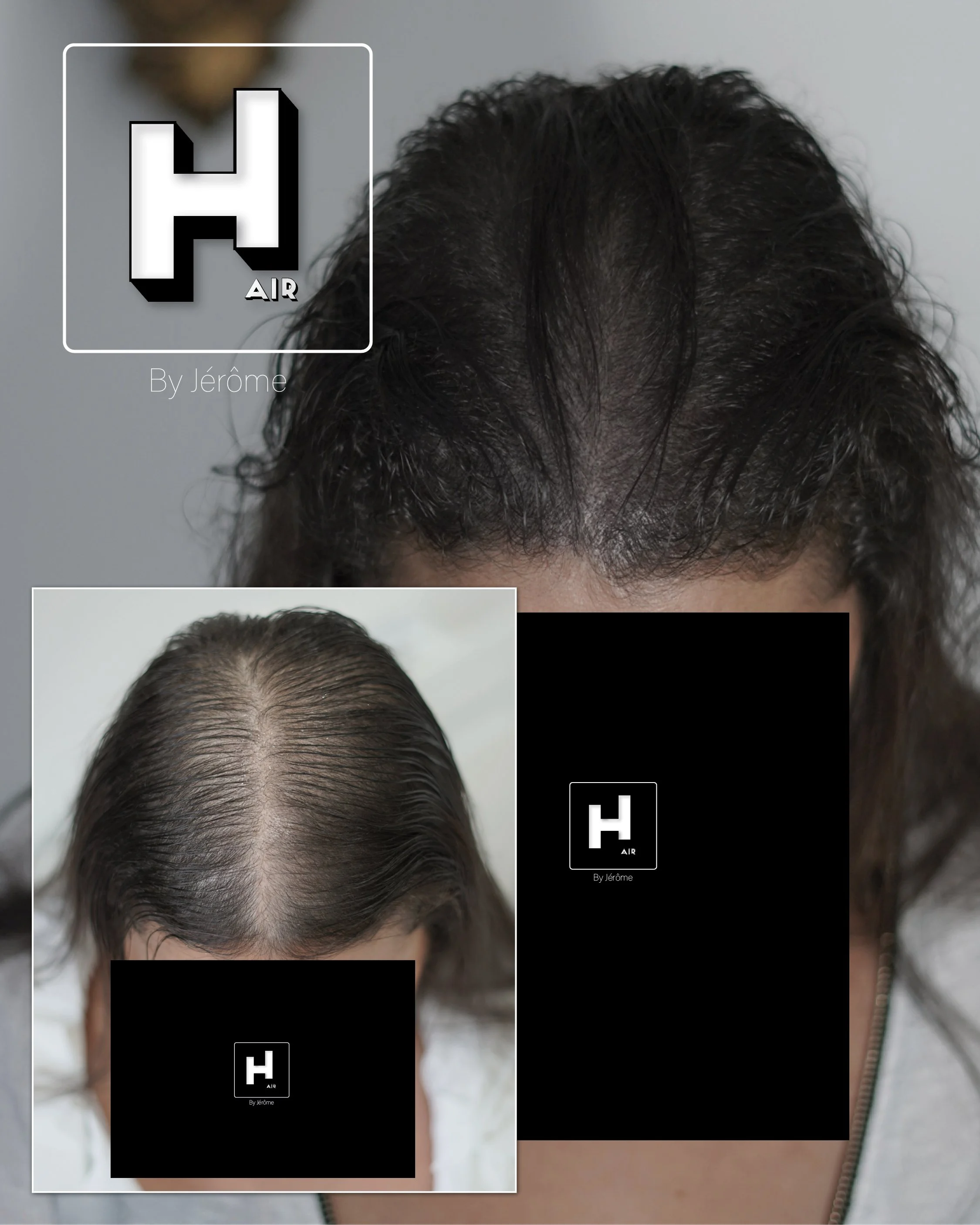 perte cheveux femme solution calvitie france belgique2.jpg