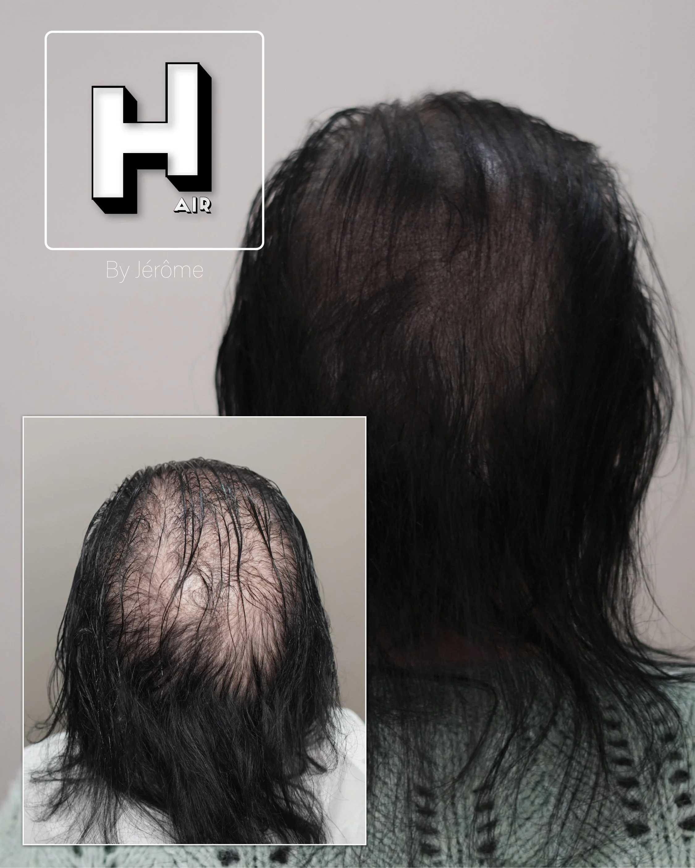 pigmentation cheveux tatouage calvitie femme5.jpg