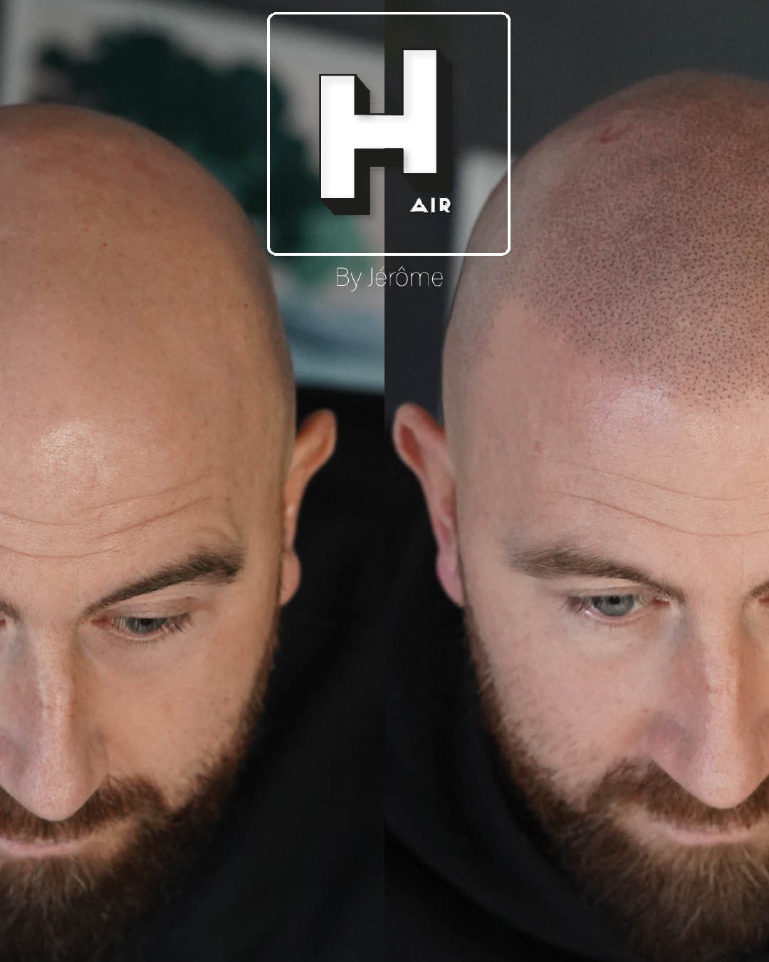 Hair by jerome effet rasé micropigmentation capillaire6.jpg