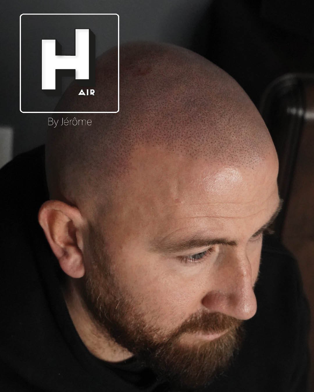 Hair by jerome effet rasé micropigmentation capillaire9.jpg