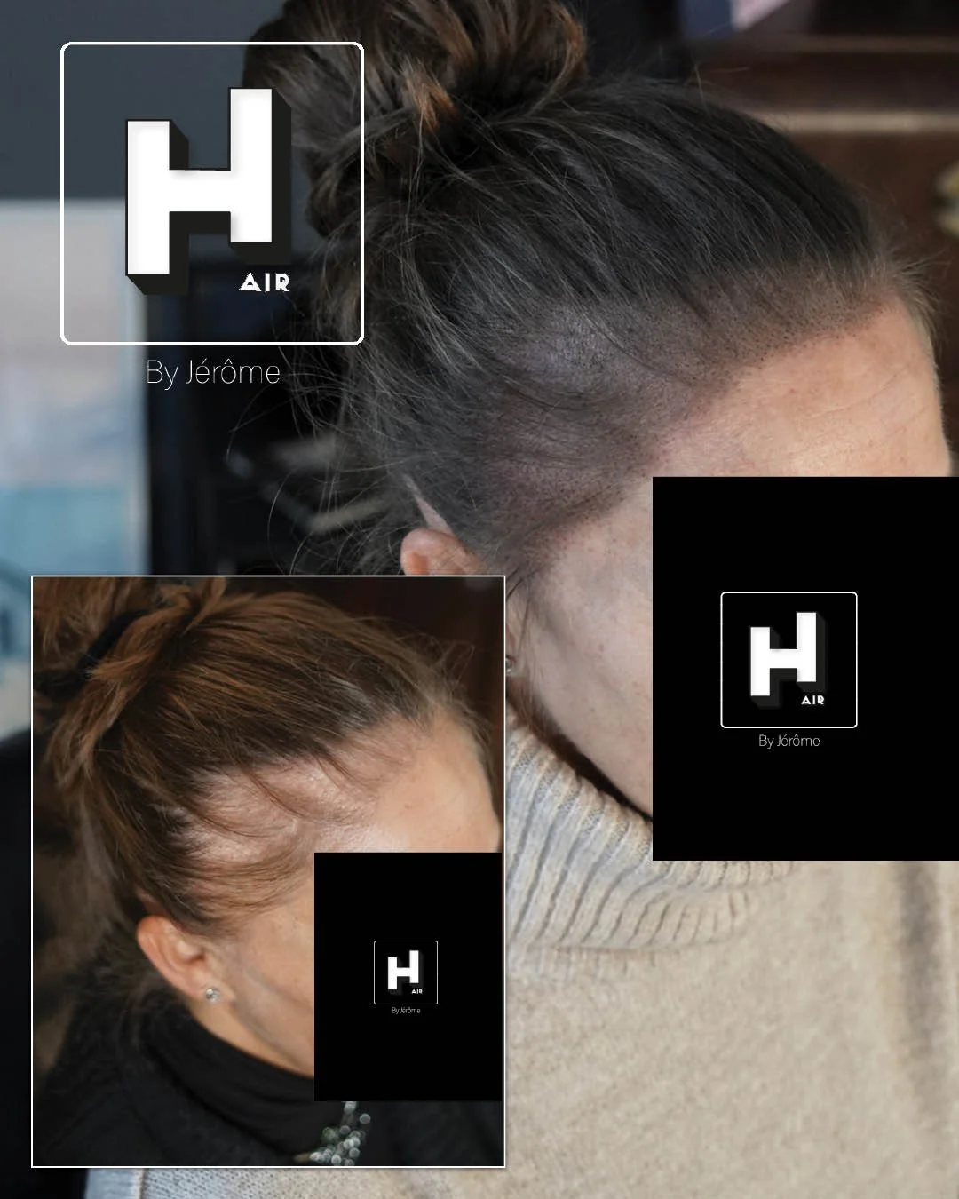 densité cheveux femme alopecie andro.jpg