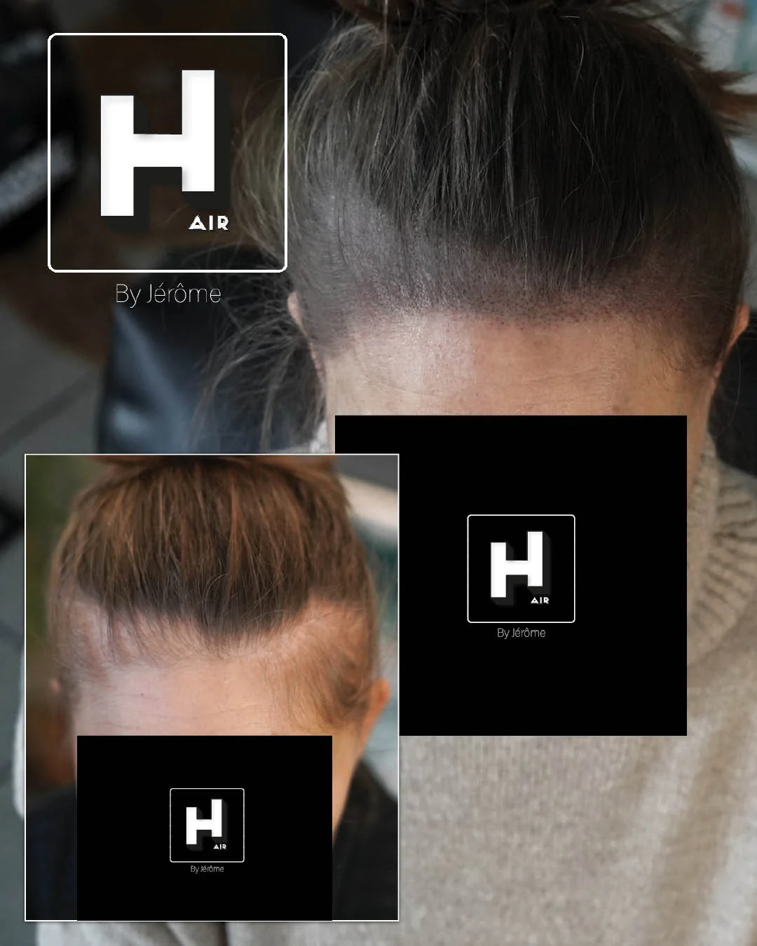 densité cheveux femme alopecie andro2.jpg