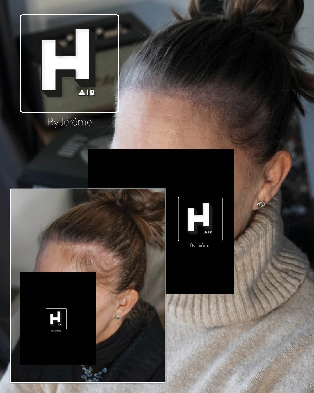 densité cheveux femme alopecie andro3.jpg