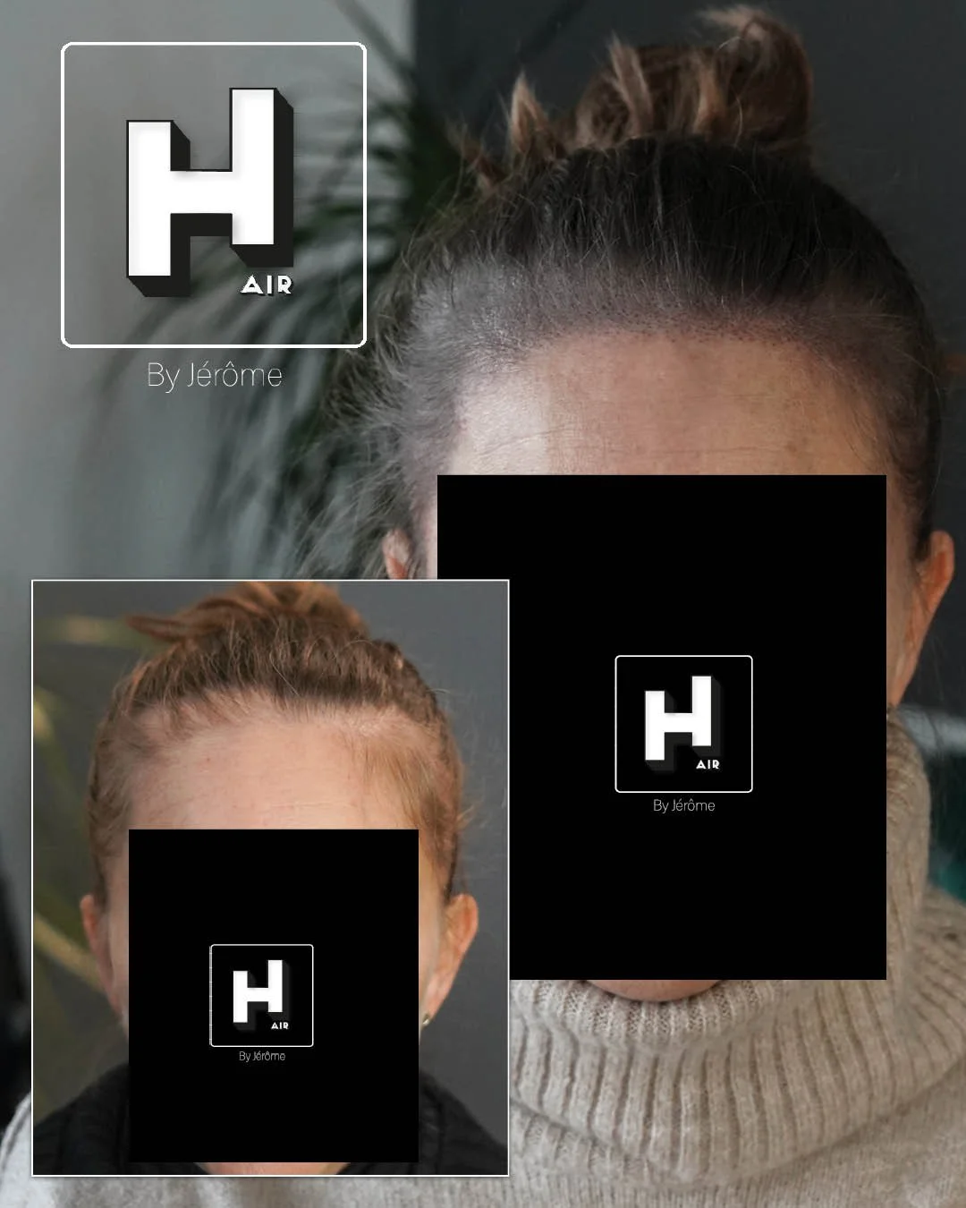 densité cheveux femme alopecie andro4.jpg