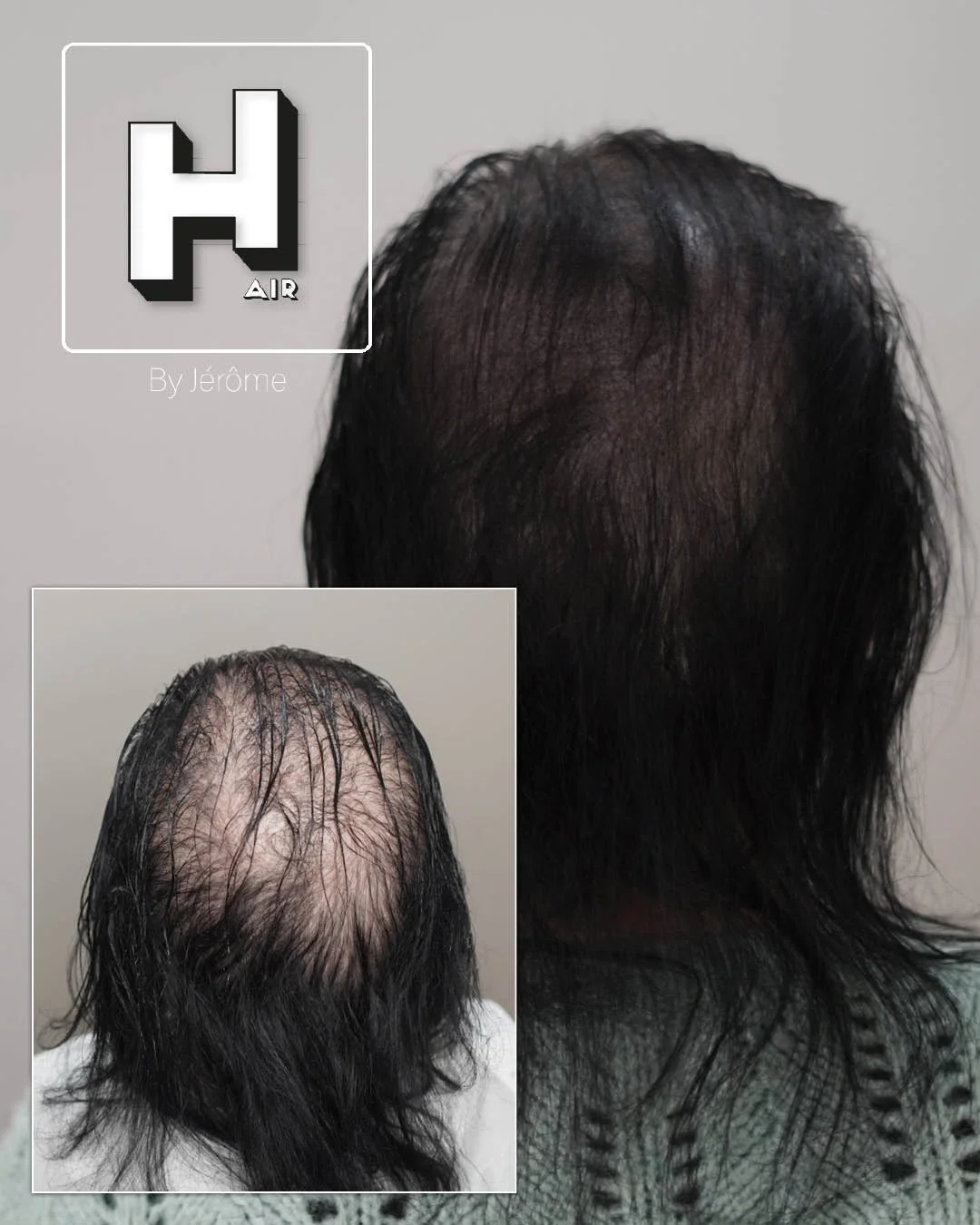 perte cheveux femme2.jpg