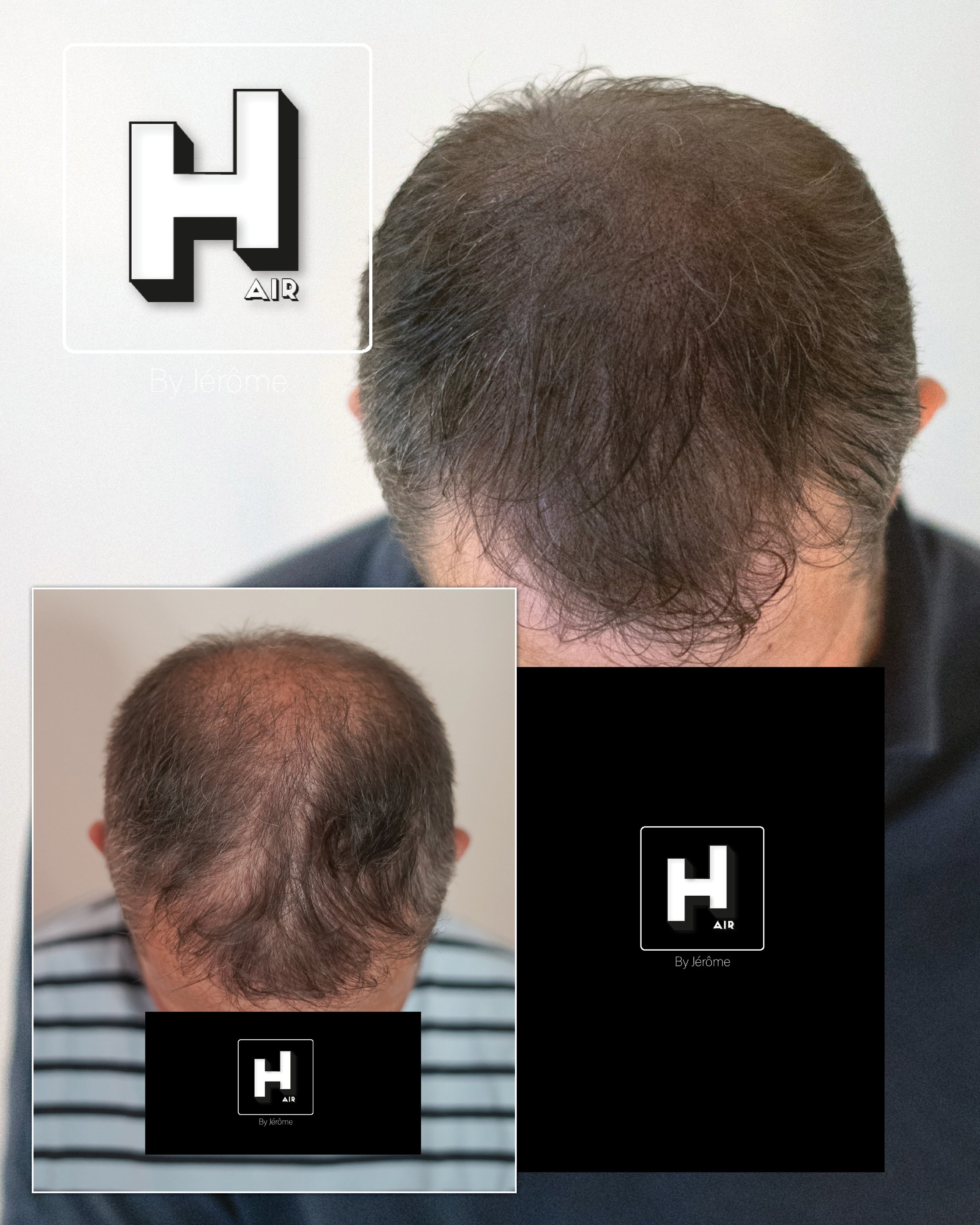 densité cheveux homme tatouage cammouflage greffe cheveux turquie2.jpg
