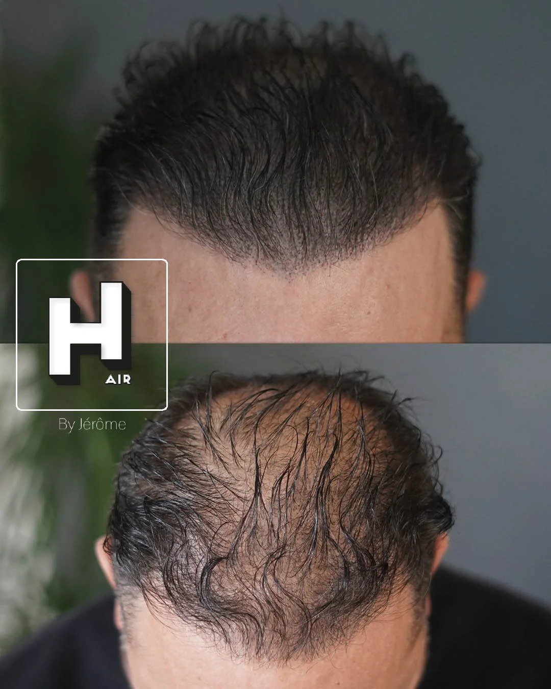 densité cheveux namur greffe de cheveux micropigmentation capillaire.jpg