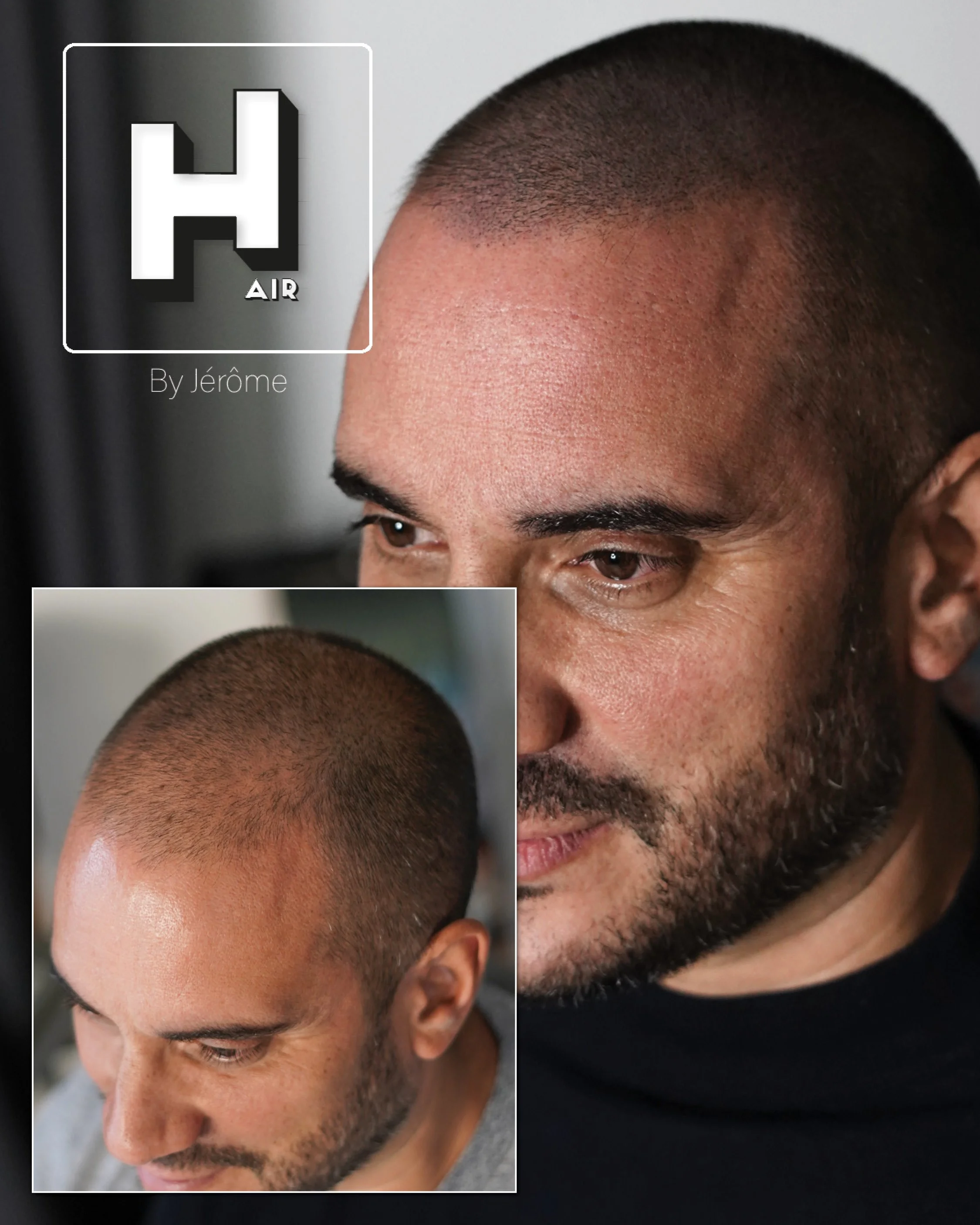 dentité homme calvitire luxembourg.jpg