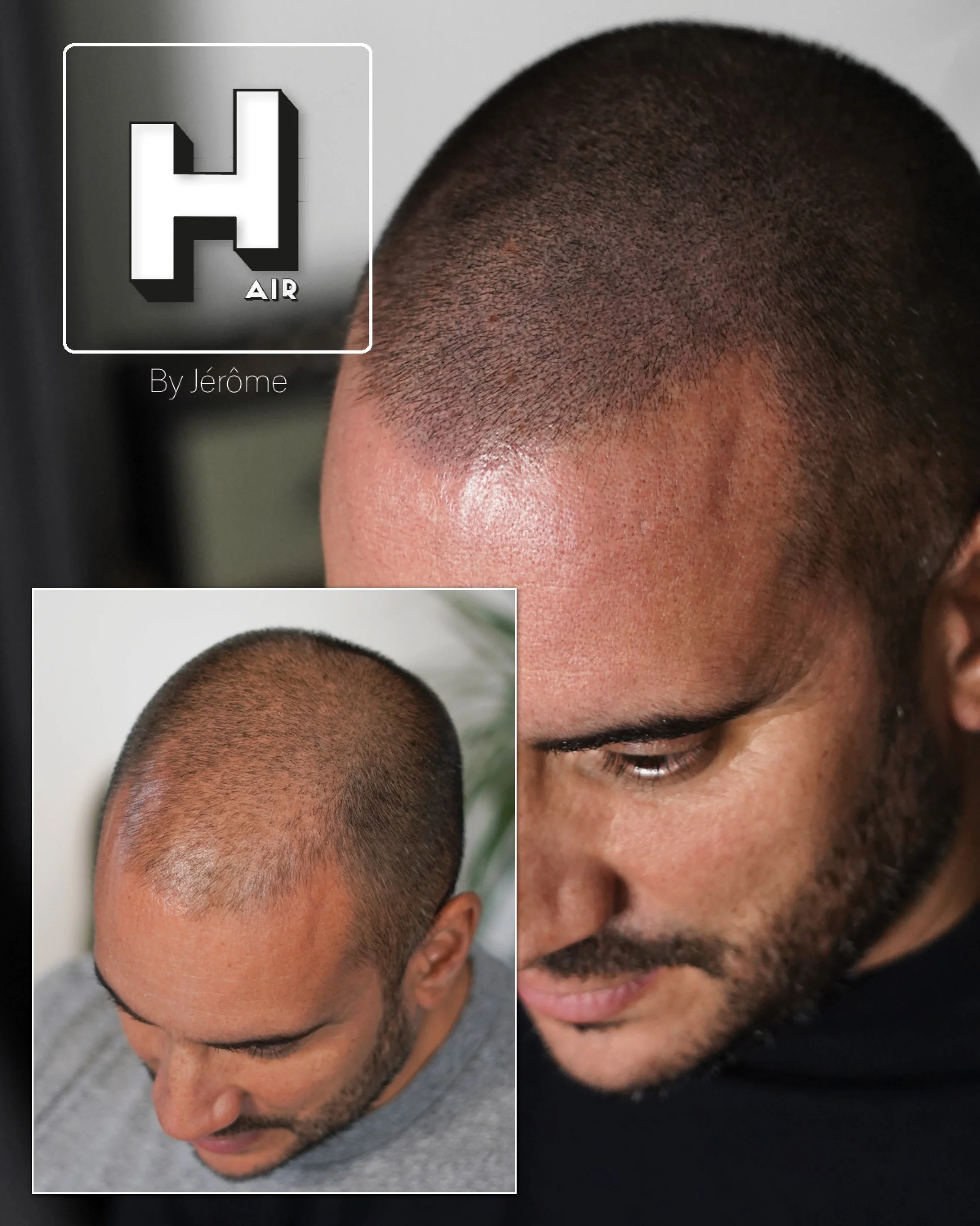 dentité homme calvitire luxembourg2.jpg