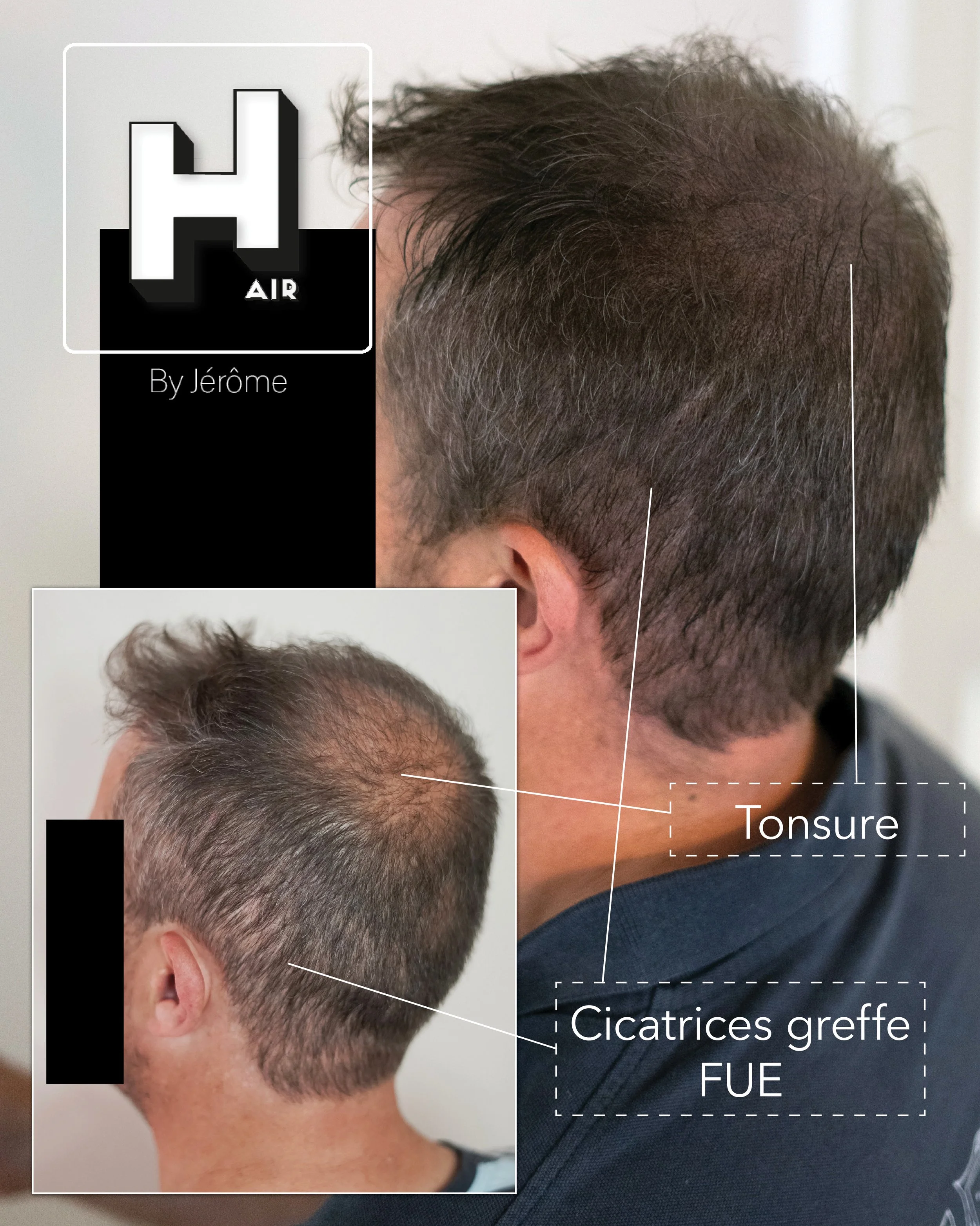 densité cheveux homme tatouage cammouflage greffe cheveux turquie3.jpg