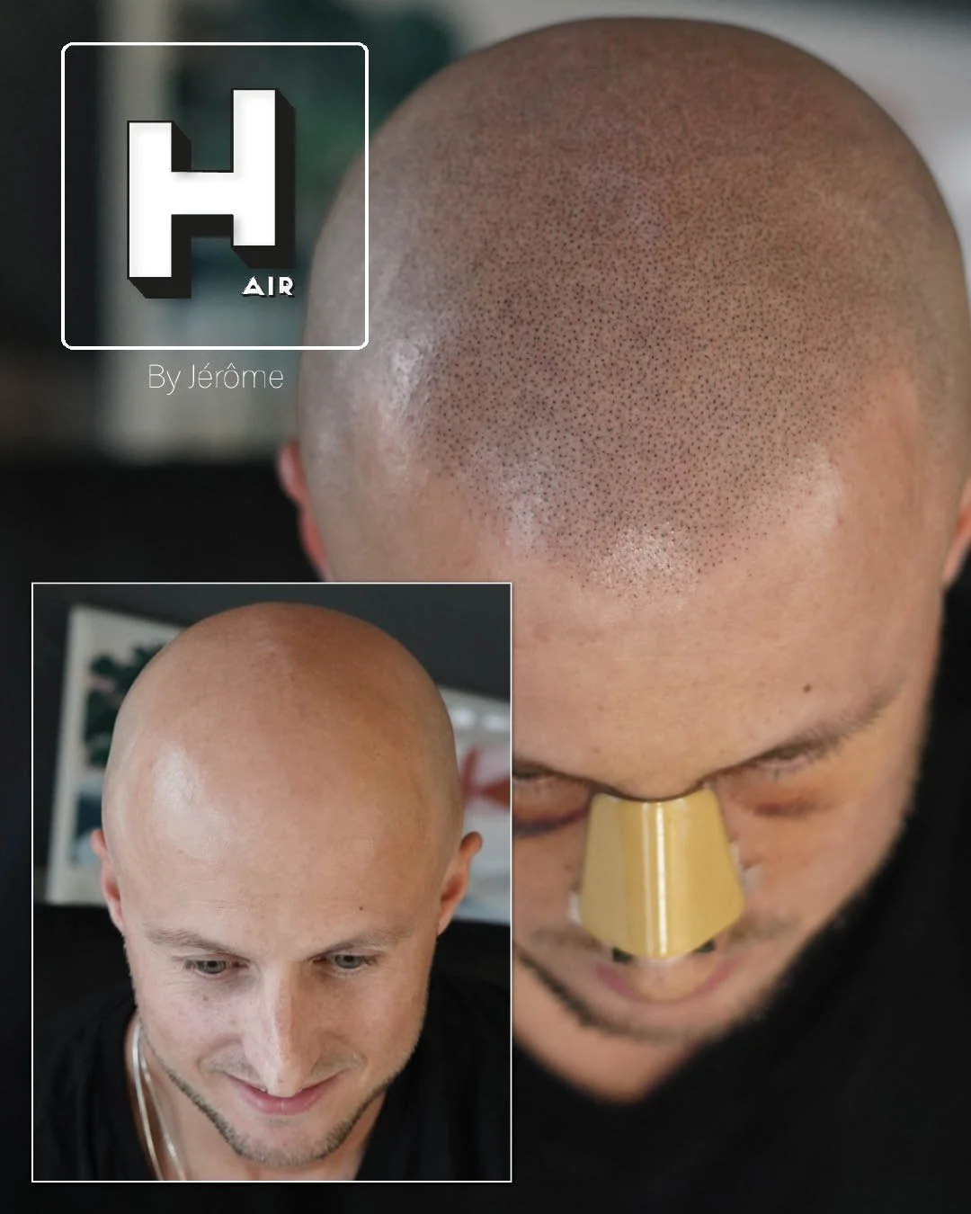 effet rasé micropigmentation a namur6.jpg