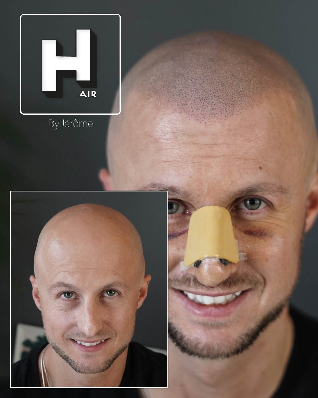 effet rasé micropigmentation a namur.jpg