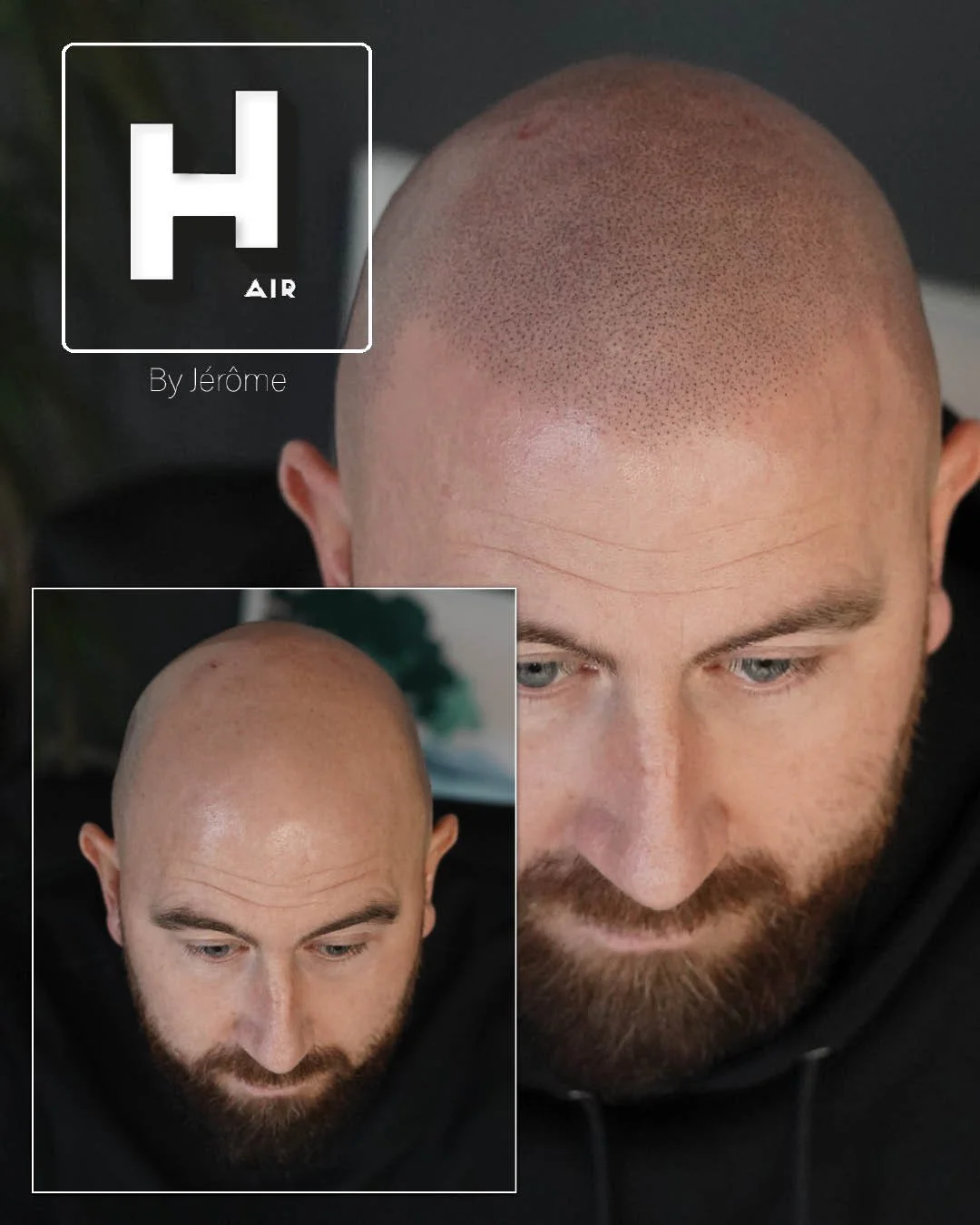 Hair by jerome effet rasé micropigmentation capillaire.jpg