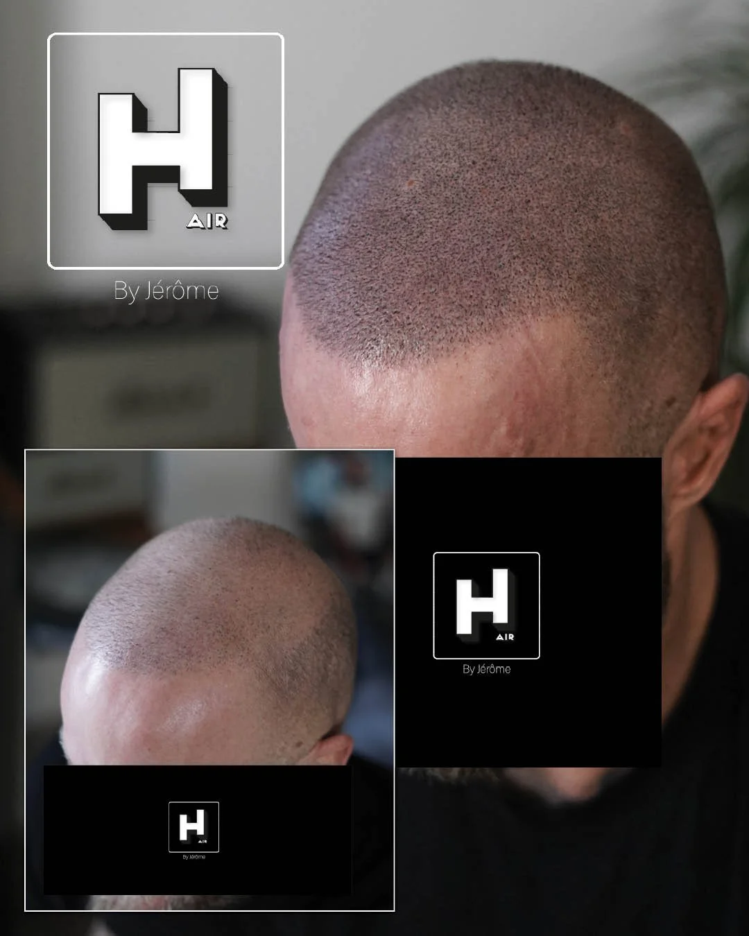 correction greffe turquie ratée hair by jerome Micropigmentation capillaire namur belgique luxembourg.jpg