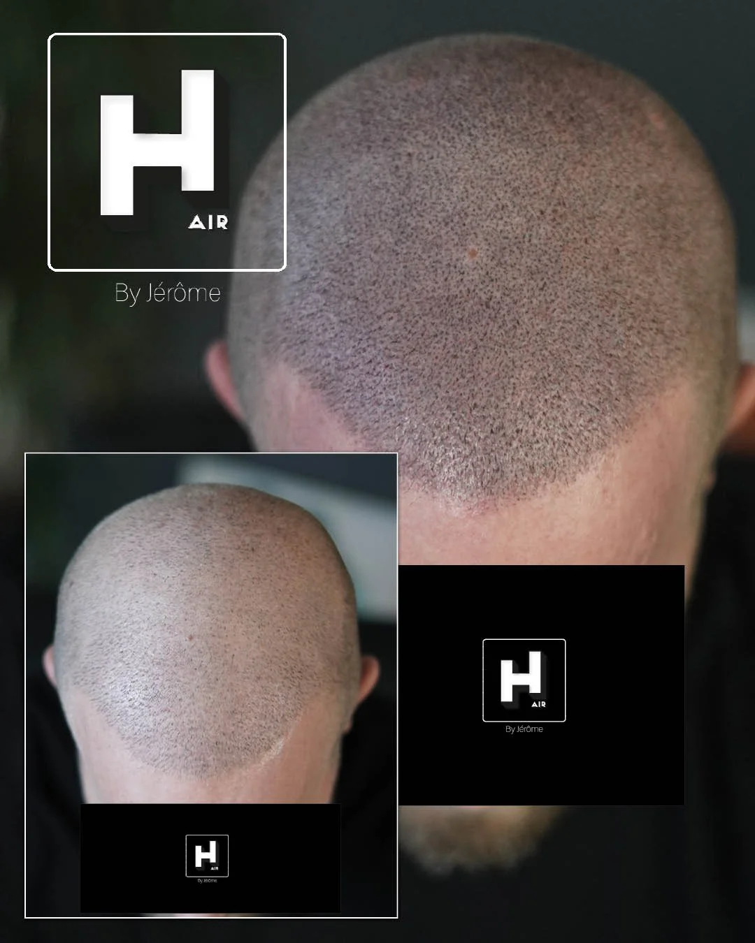 correction greffe turquie ratée hair by jerome Micropigmentation capillaire namur belgique luxembourg4.jpg