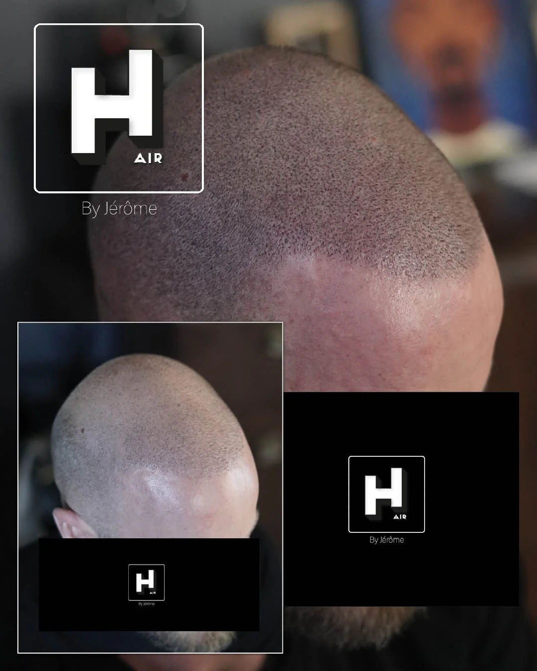correction greffe turquie ratée hair by jerome Micropigmentation capillaire namur belgique luxembourg7.jpg