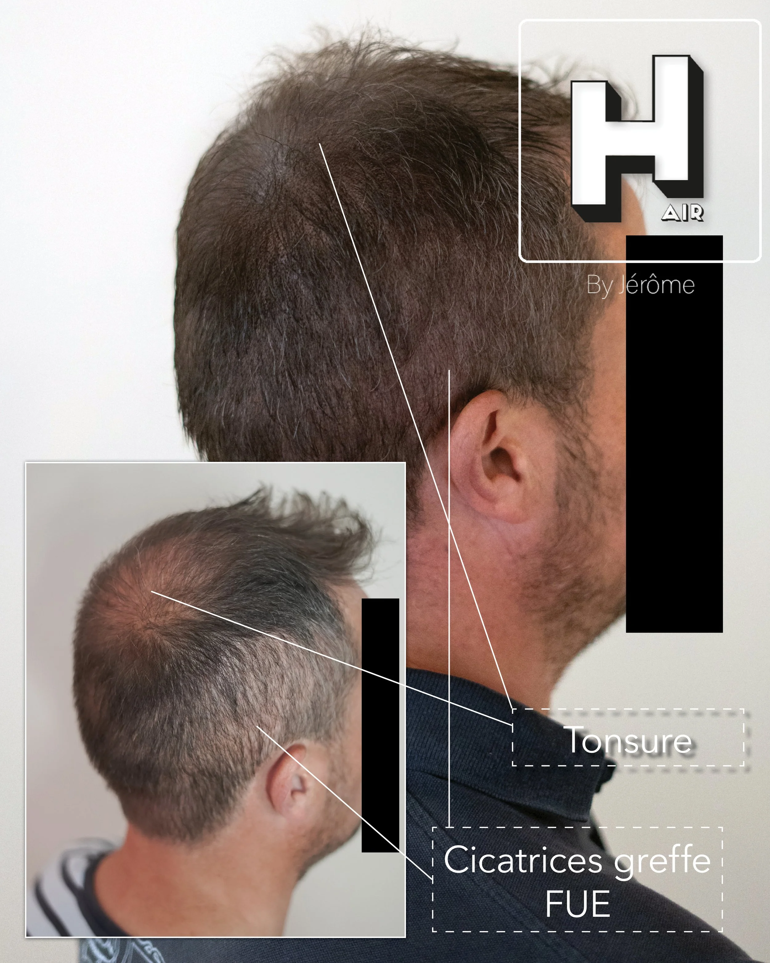 densité cheveux homme tatouage cammouflage greffe cheveux turquie6.jpg