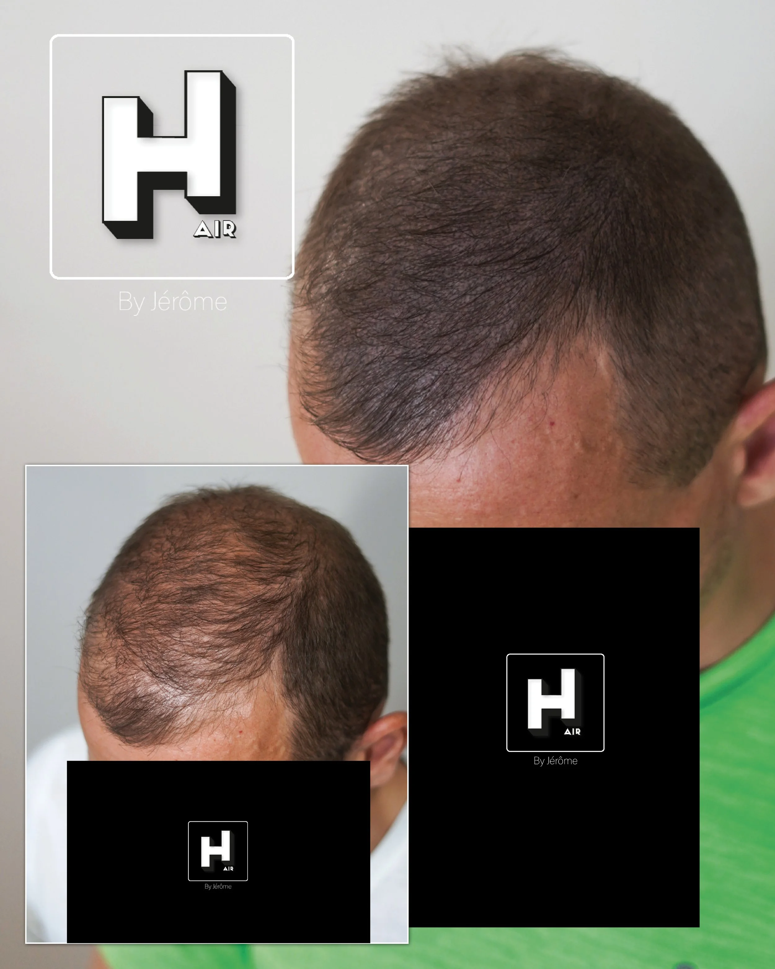 densité micropigmentation capillaire homme perte de cheveux wallonie2.jpg