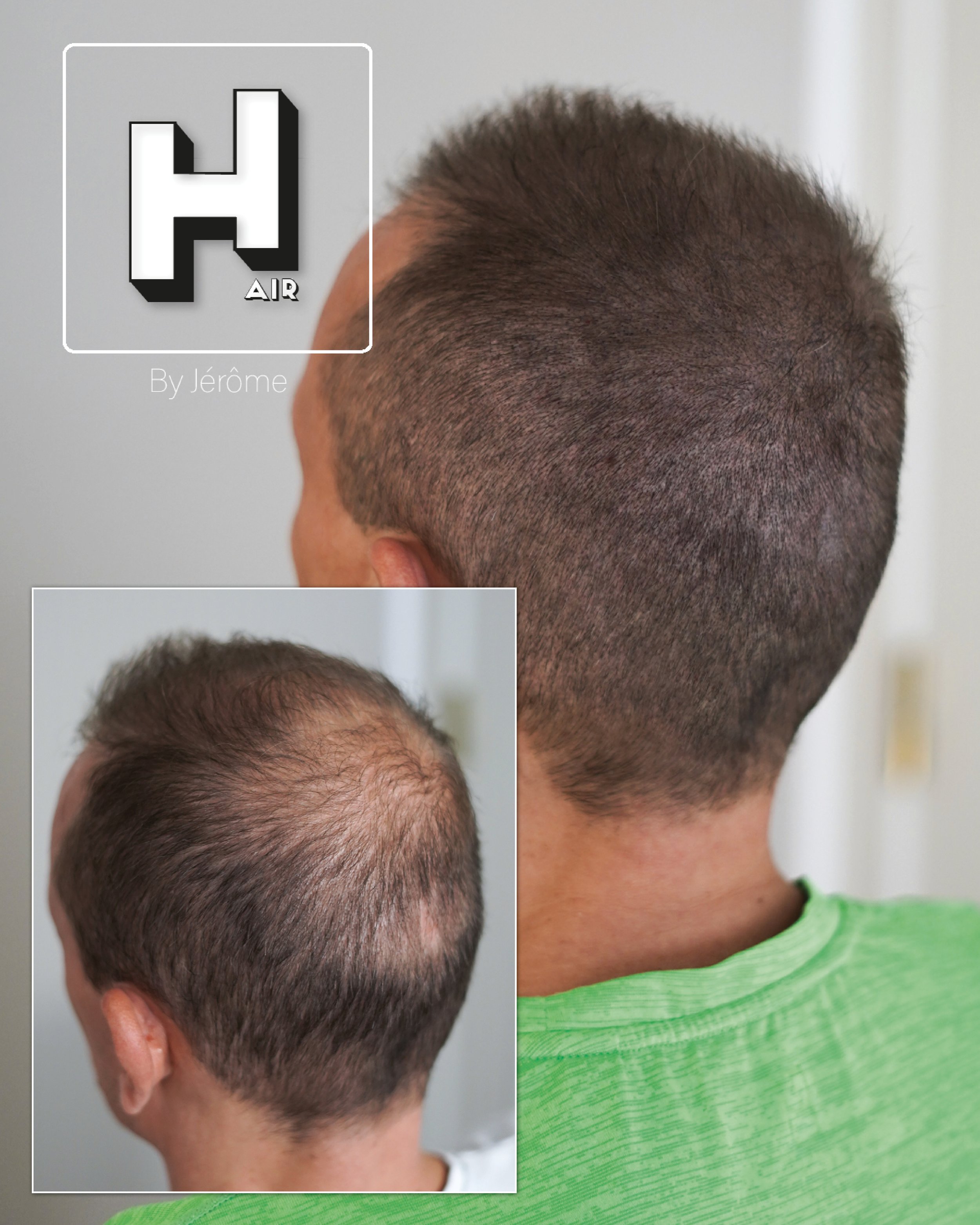 densité micropigmentation capillaire homme perte de cheveux wallonie3.jpg
