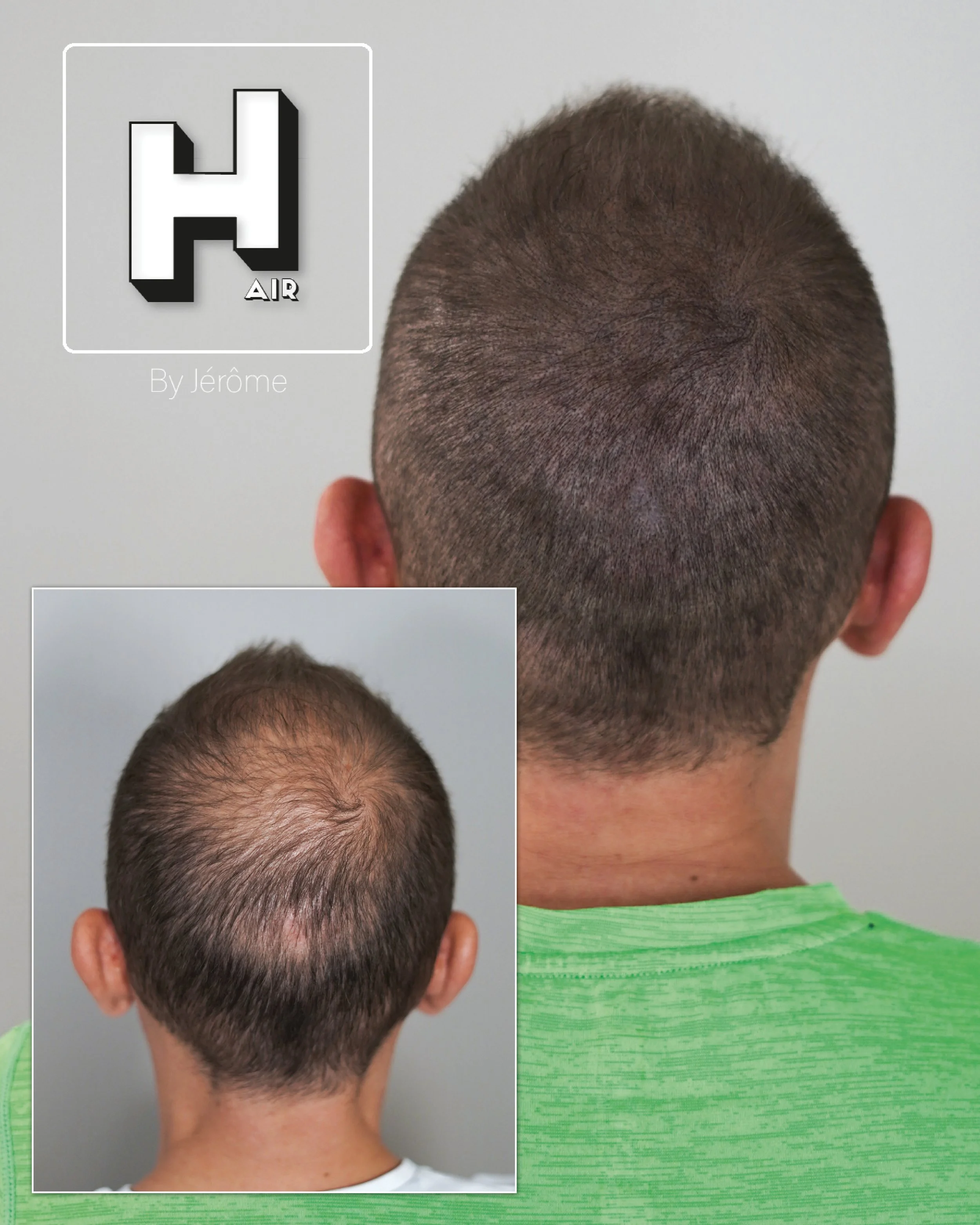 densité micropigmentation capillaire homme perte de cheveux wallonie4.jpg