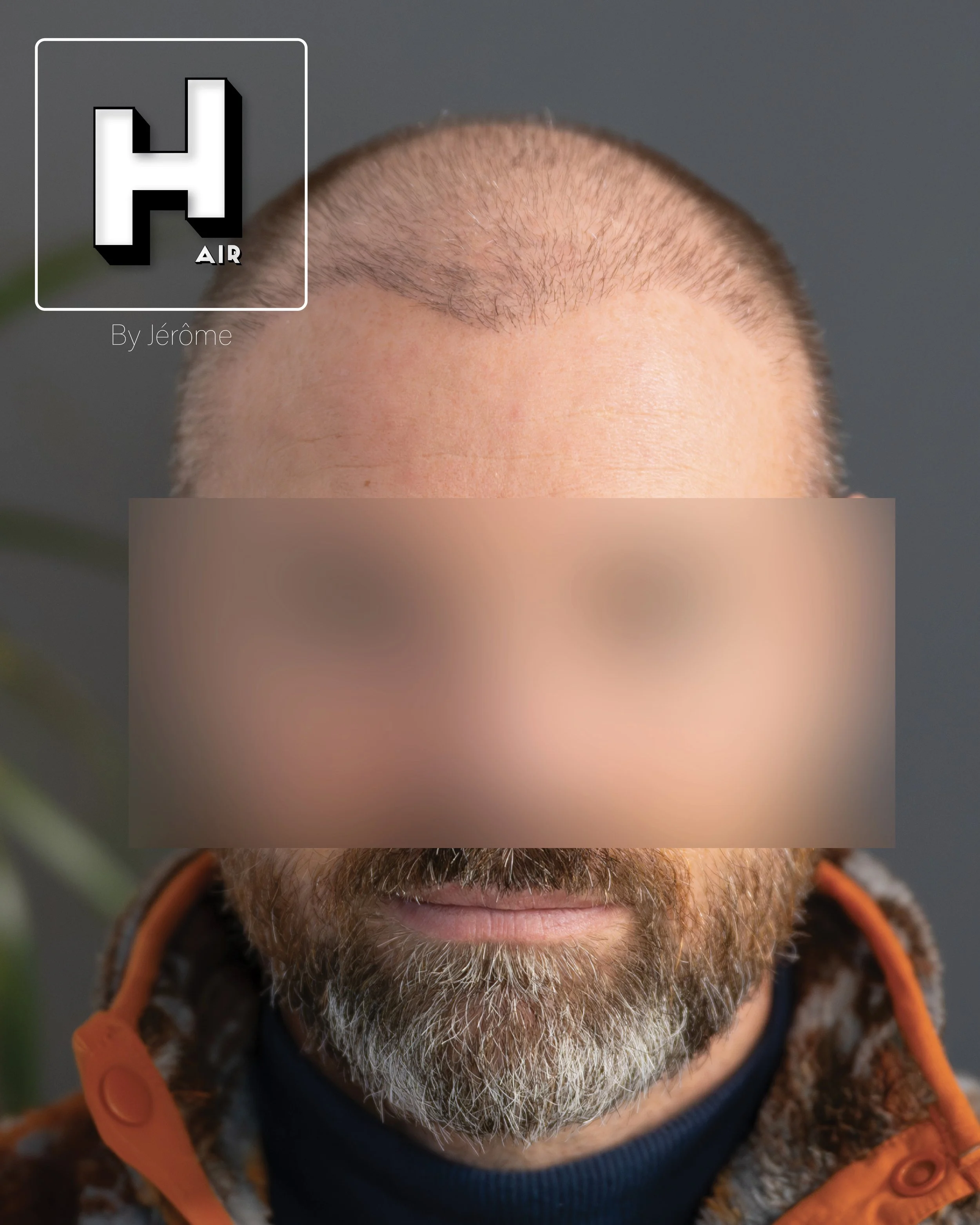 smp  effet rasé greffe cheveux turquie fue smpartistbelgium hairbyjerome2.jpg