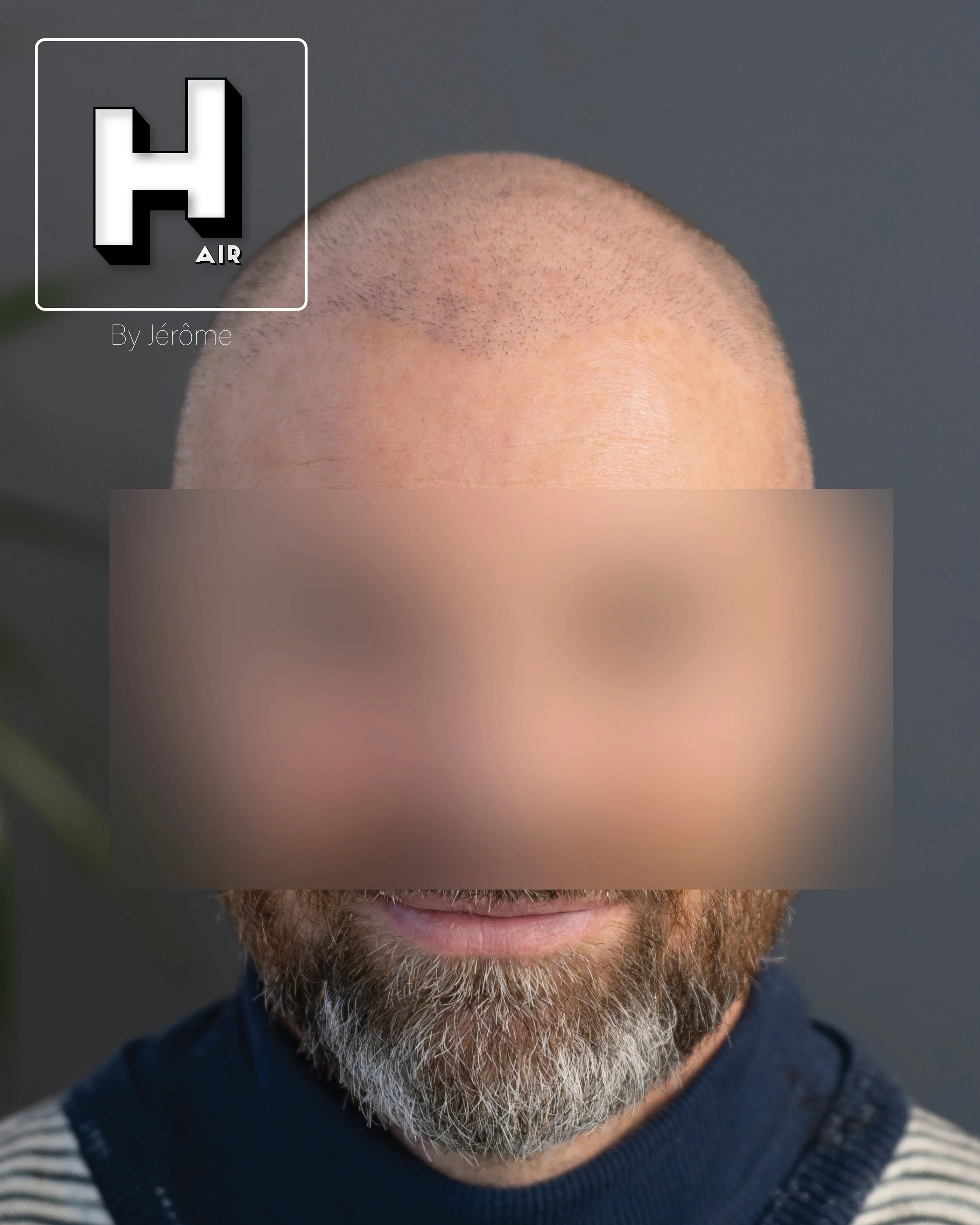 smp  effet rasé greffe cheveux turquie fue smpartistbelgium hairbyjerome3.jpg