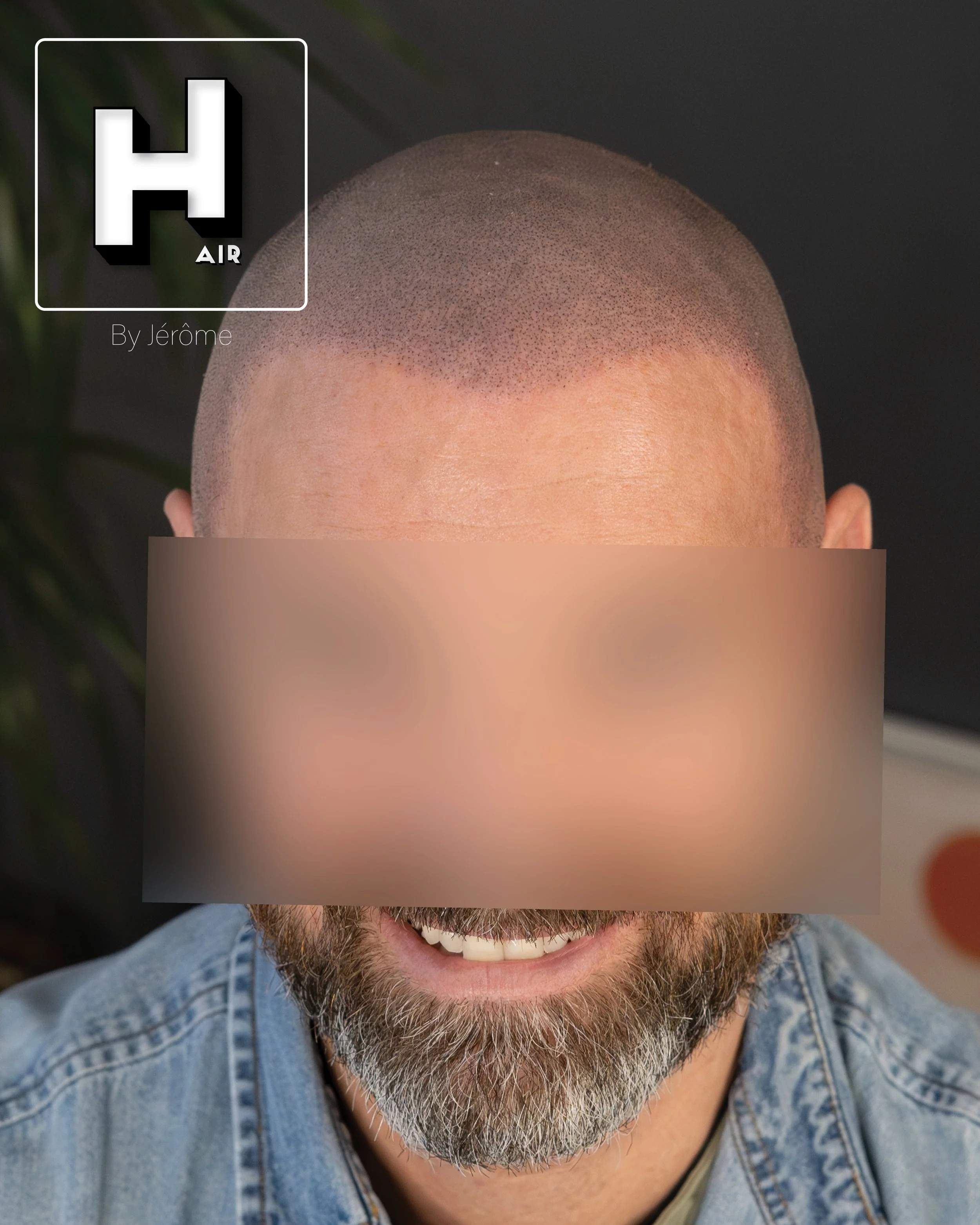 smp  effet rasé greffe cheveux turquie fue smpartistbelgium hairbyjerome4.jpg