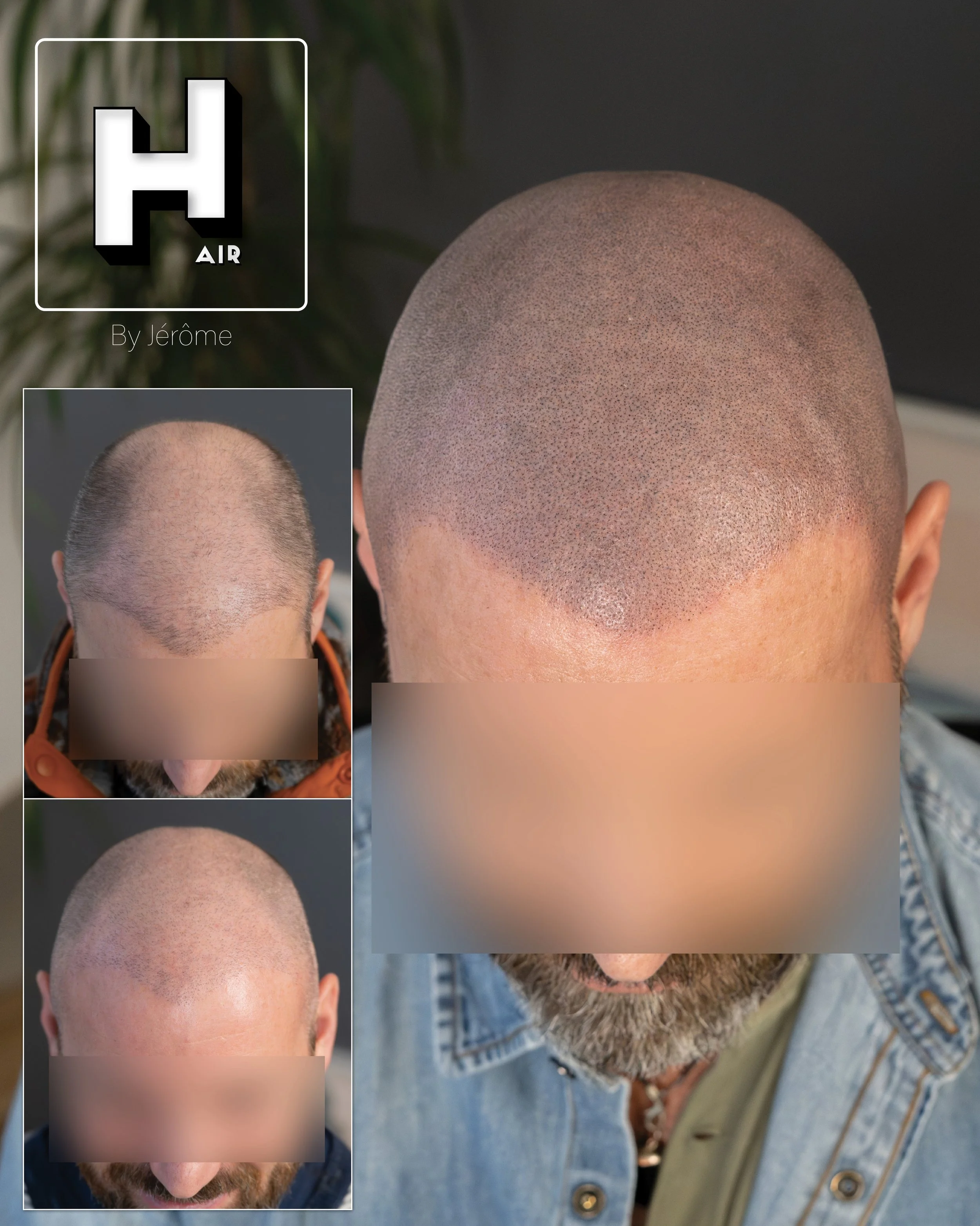 smp  effet rasé greffe cheveux turquie fue smpartistbelgium hairbyjerome5.jpg
