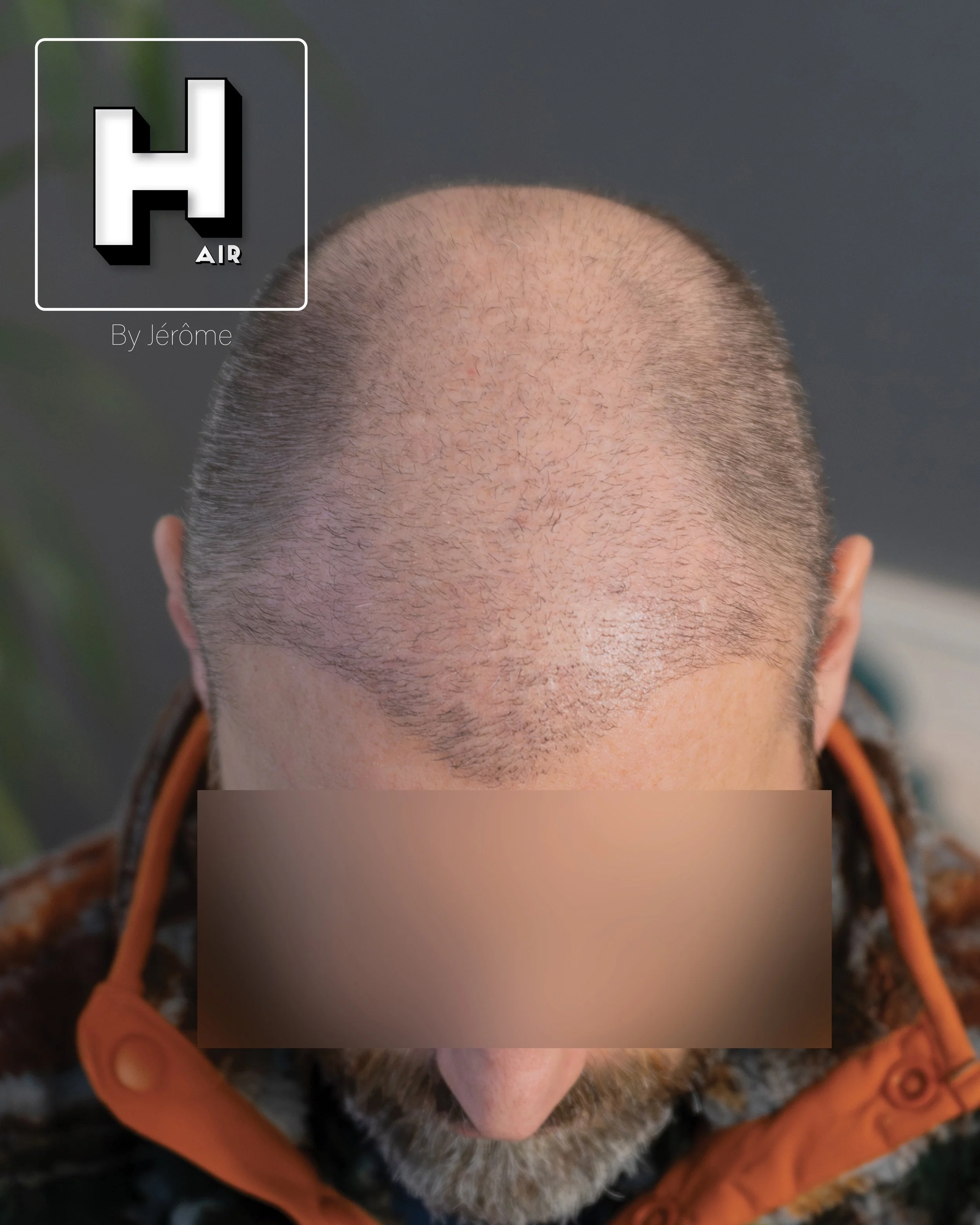 smp  effet rasé greffe cheveux turquie fue smpartistbelgium hairbyjerome6.jpg