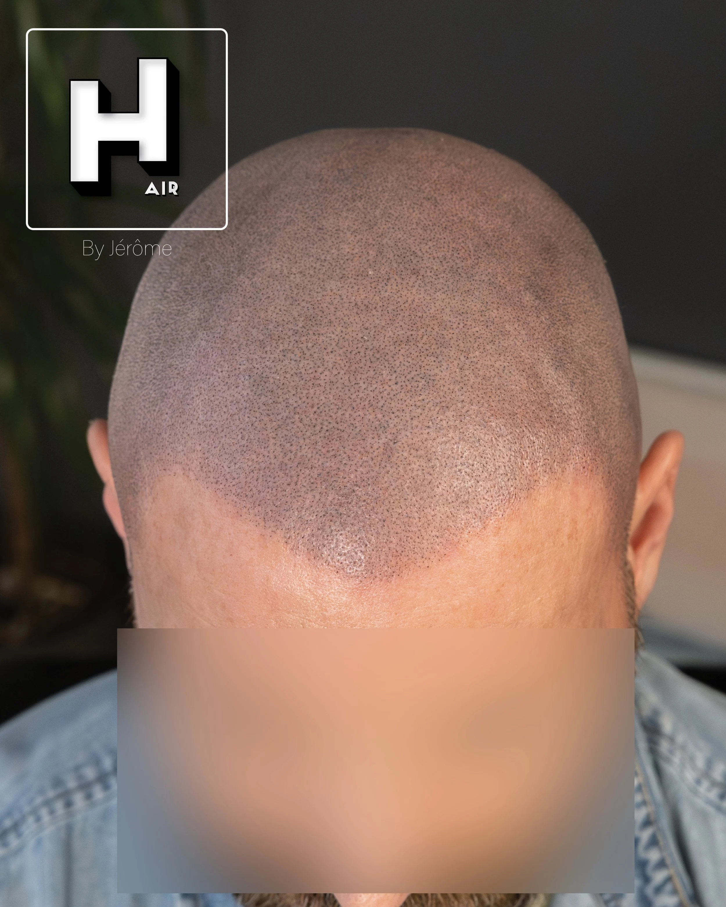 smp  effet rasé greffe cheveux turquie fue smpartistbelgium hairbyjerome8.jpg