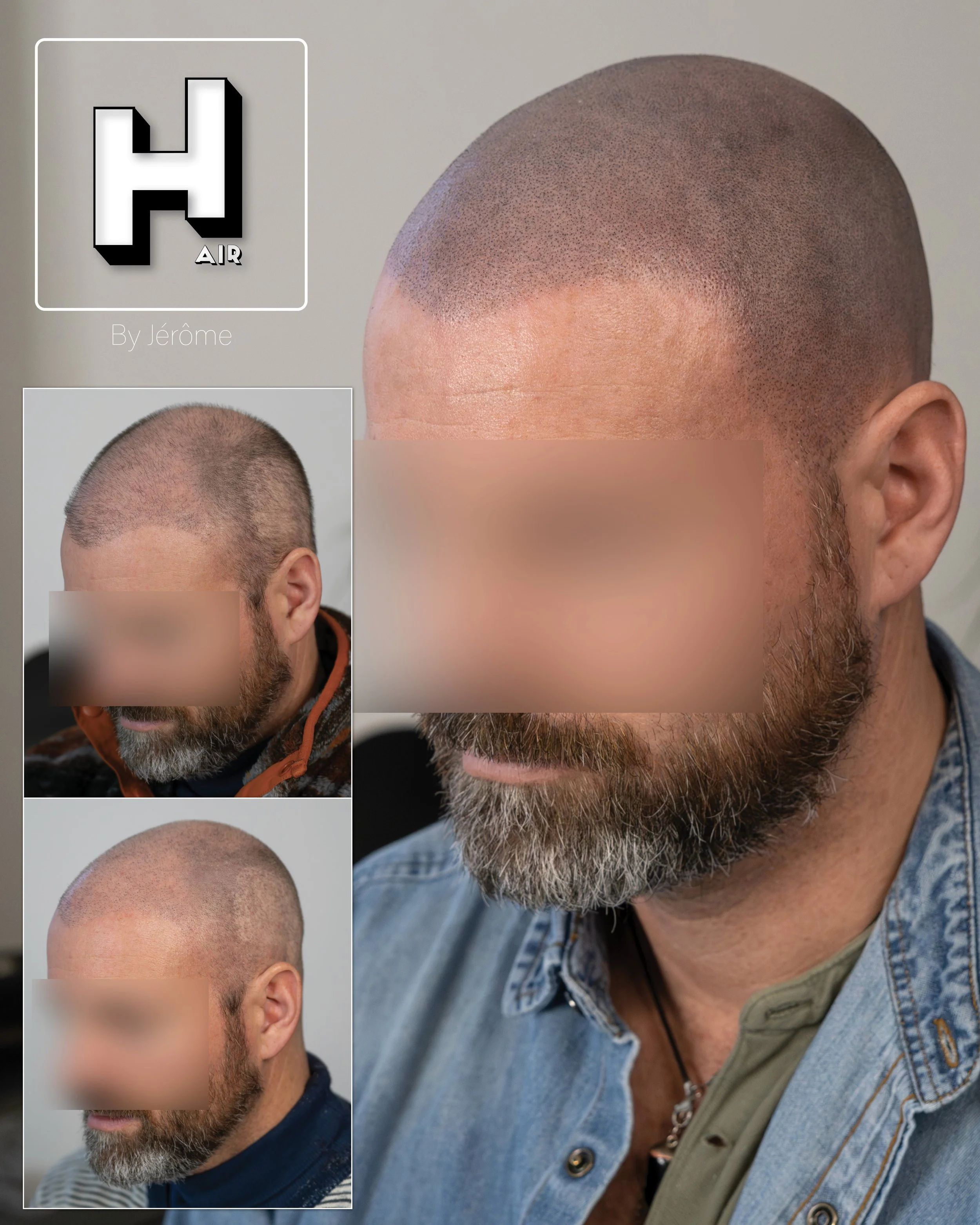 smp  effet rasé greffe cheveux turquie fue smpartistbelgium hairbyjerome9.jpg
