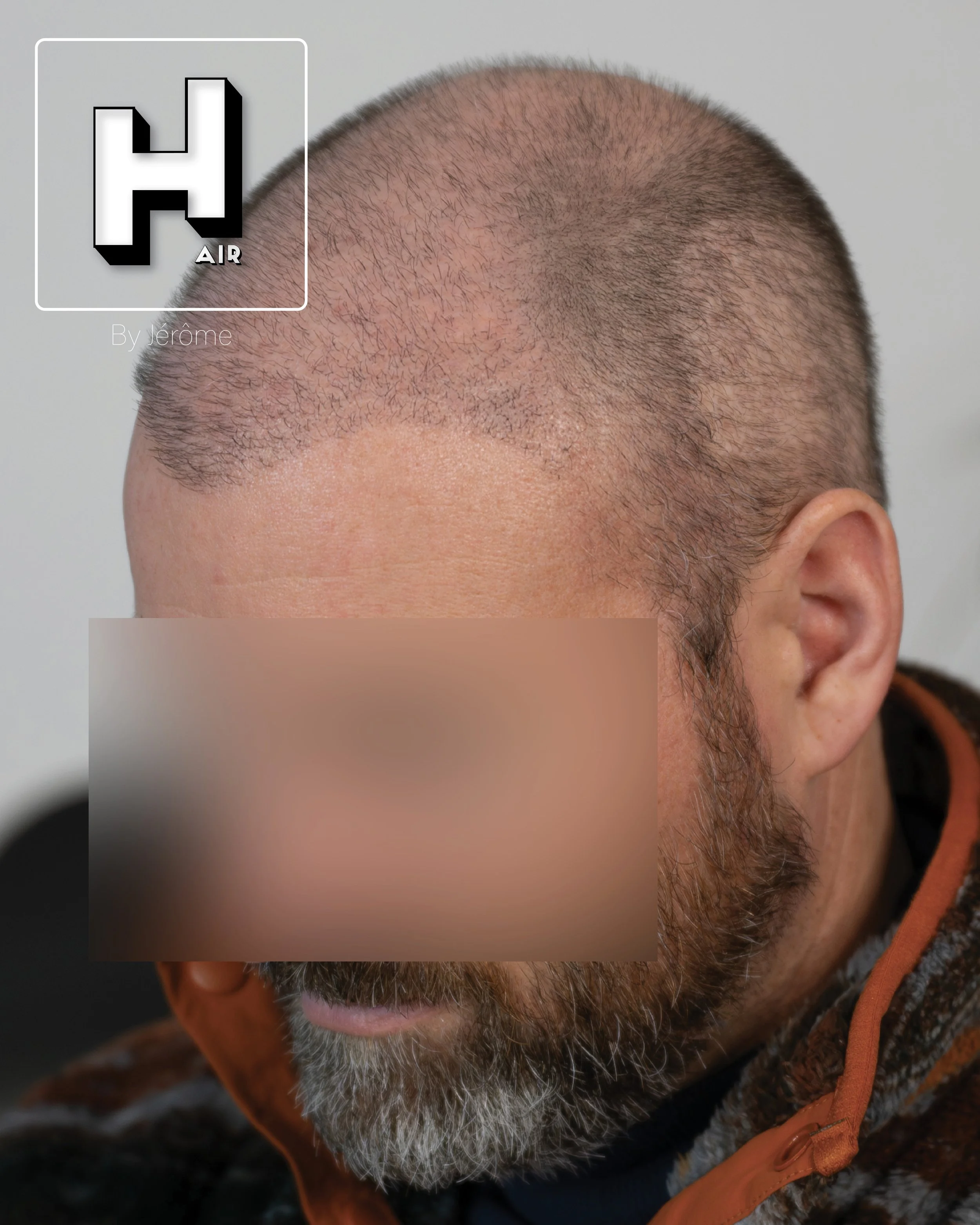 smp  effet rasé greffe cheveux turquie fue smpartistbelgium hairbyjerome10.jpg