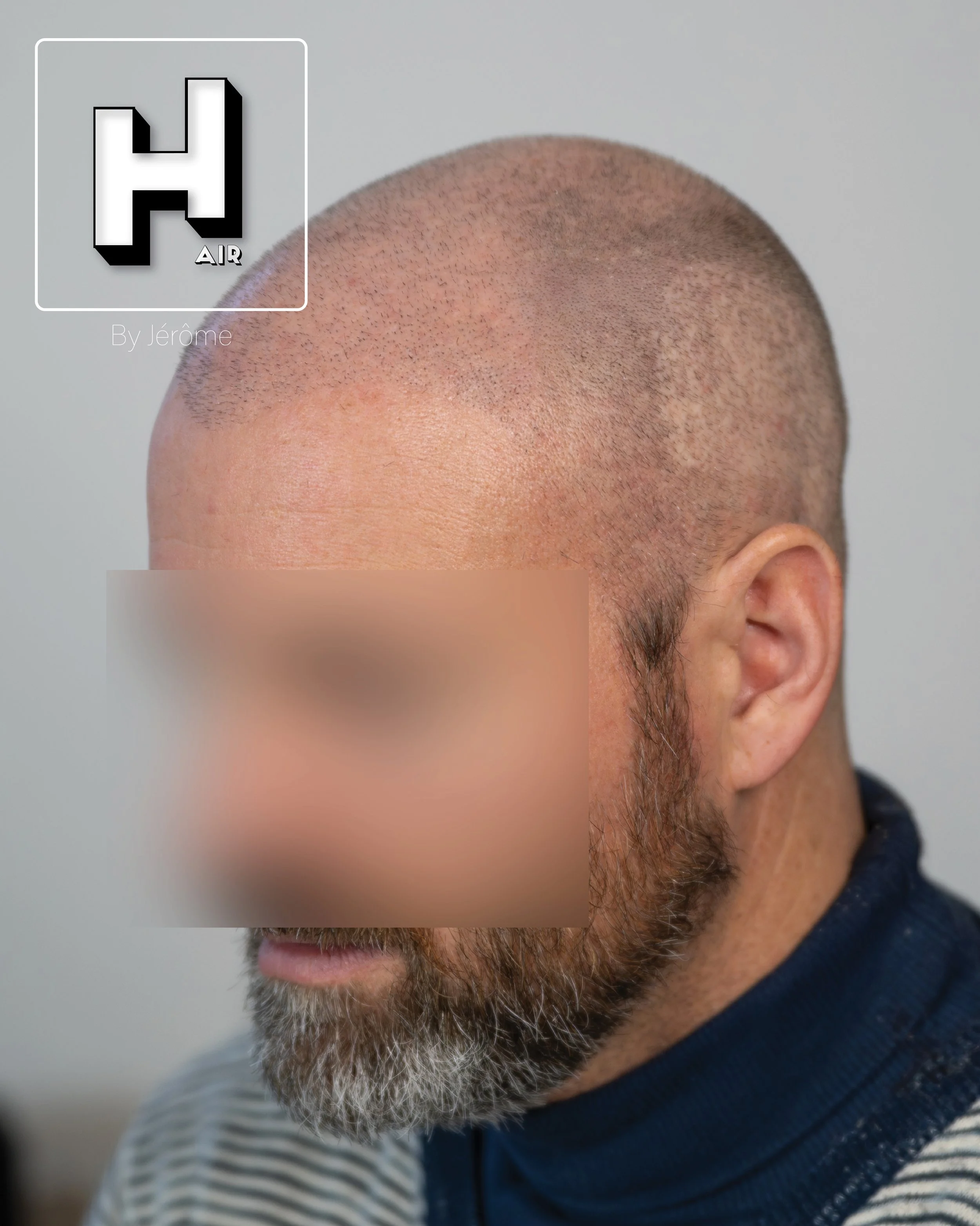 smp  effet rasé greffe cheveux turquie fue smpartistbelgium hairbyjerome11.jpg