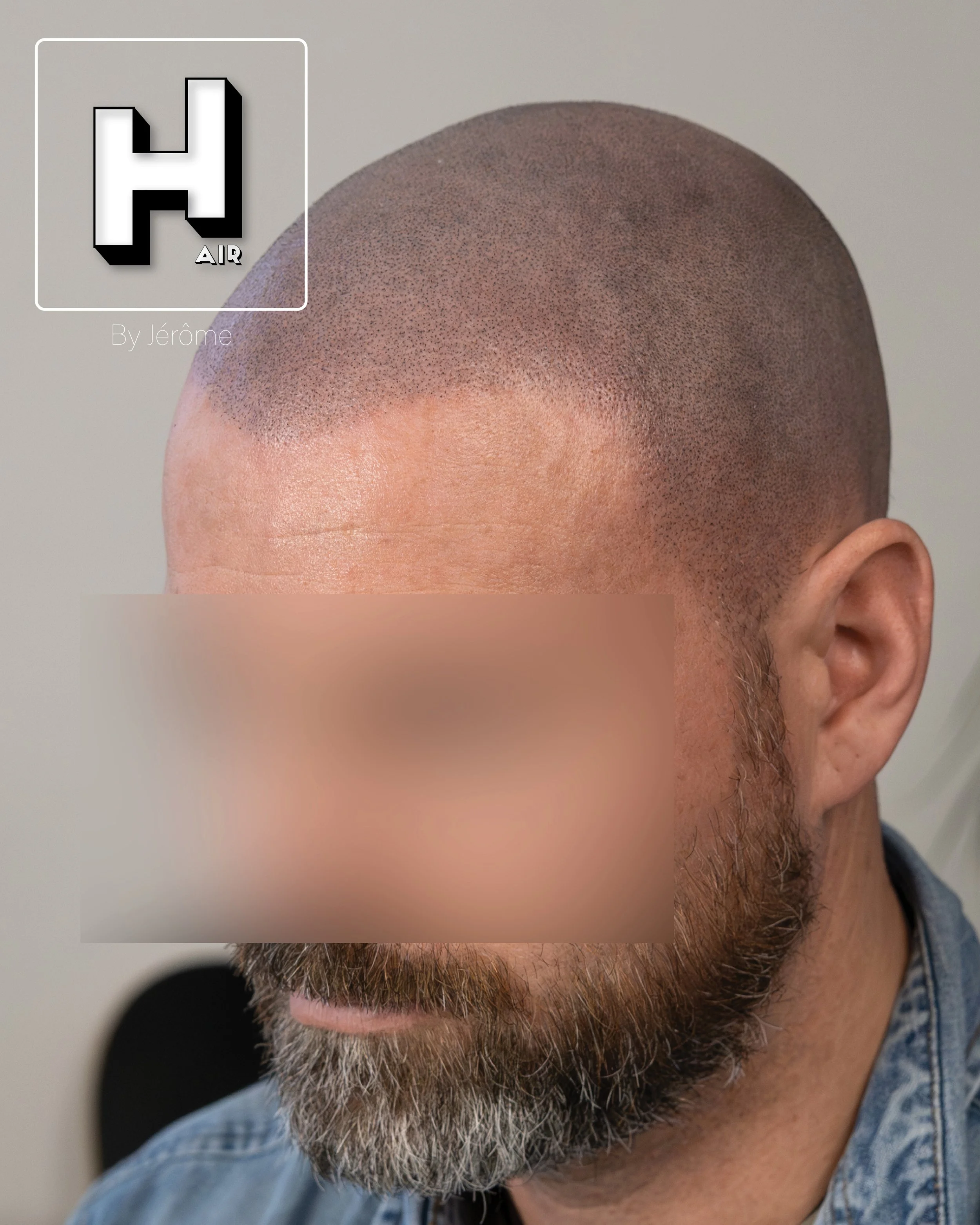 smp  effet rasé greffe cheveux turquie fue smpartistbelgium hairbyjerome12.jpg