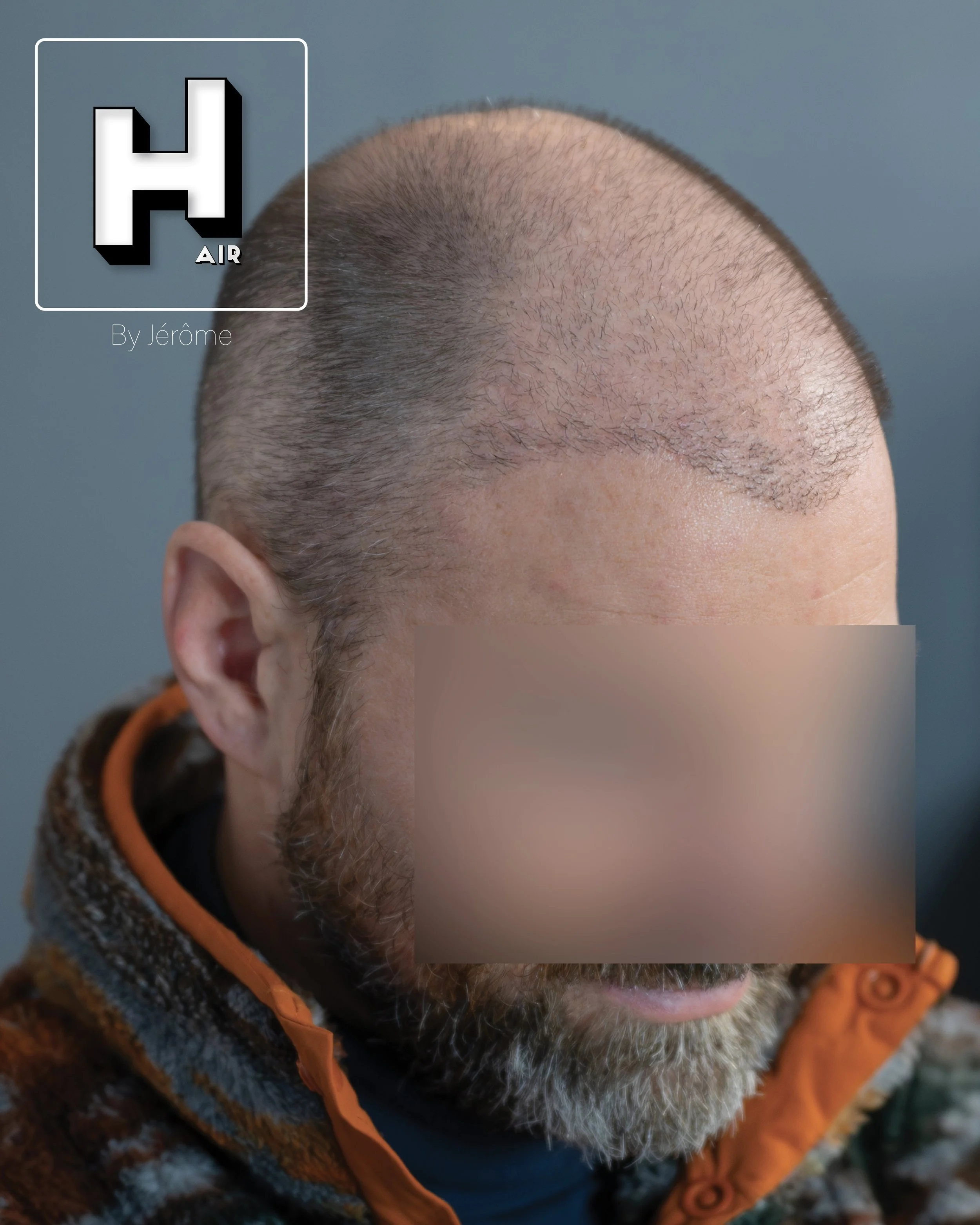 smp  effet rasé greffe cheveux turquie fue smpartistbelgium hairbyjerome14.jpg