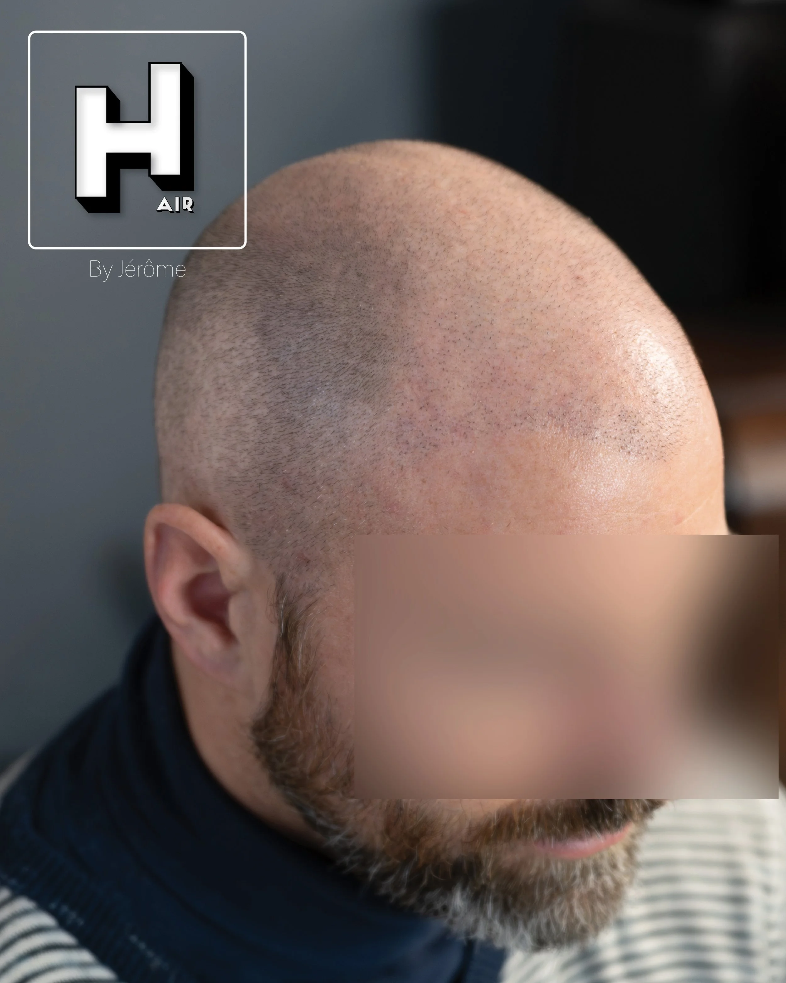 smp  effet rasé greffe cheveux turquie fue smpartistbelgium hairbyjerome15.jpg