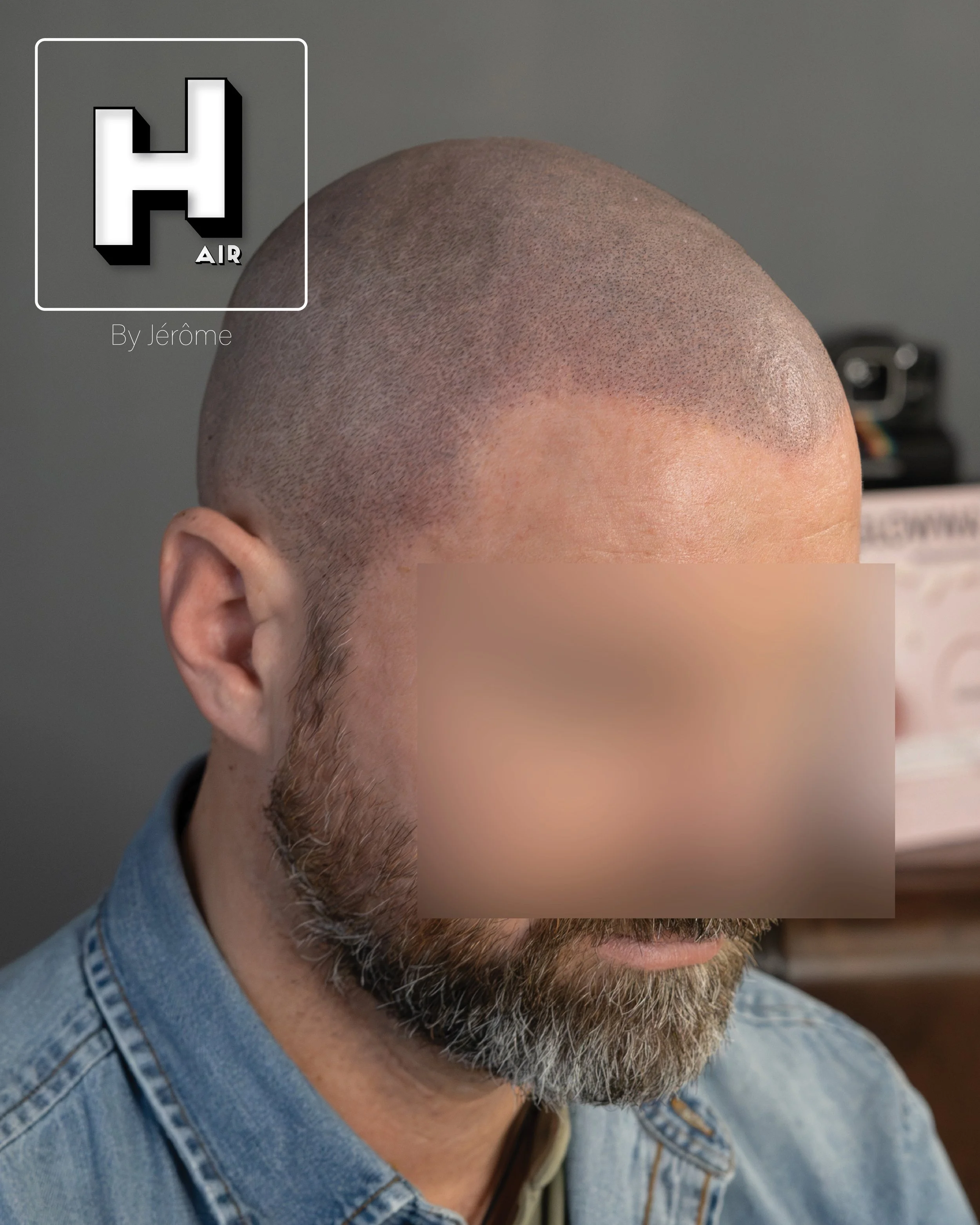 smp  effet rasé greffe cheveux turquie fue smpartistbelgium hairbyjerome16.jpg