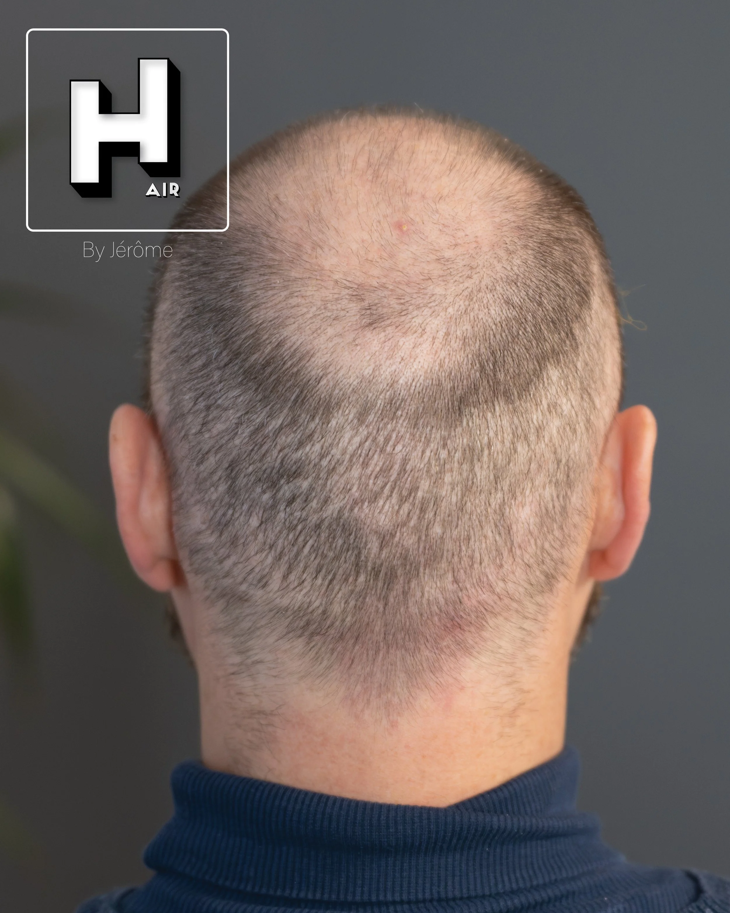 smp  effet rasé greffe cheveux turquie fue smpartistbelgium hairbyjerome18.jpg