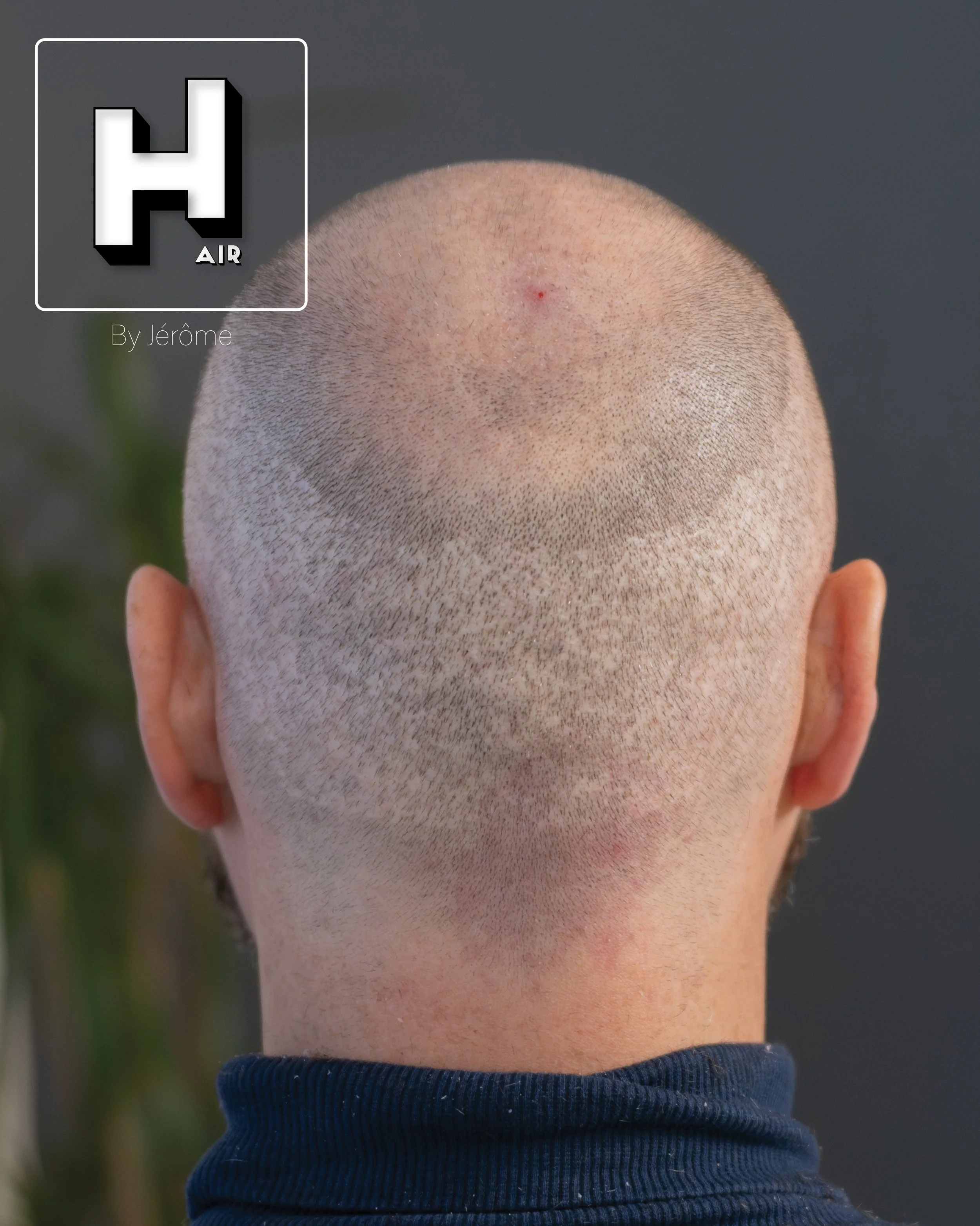 smp  effet rasé greffe cheveux turquie fue smpartistbelgium hairbyjerome19.jpg