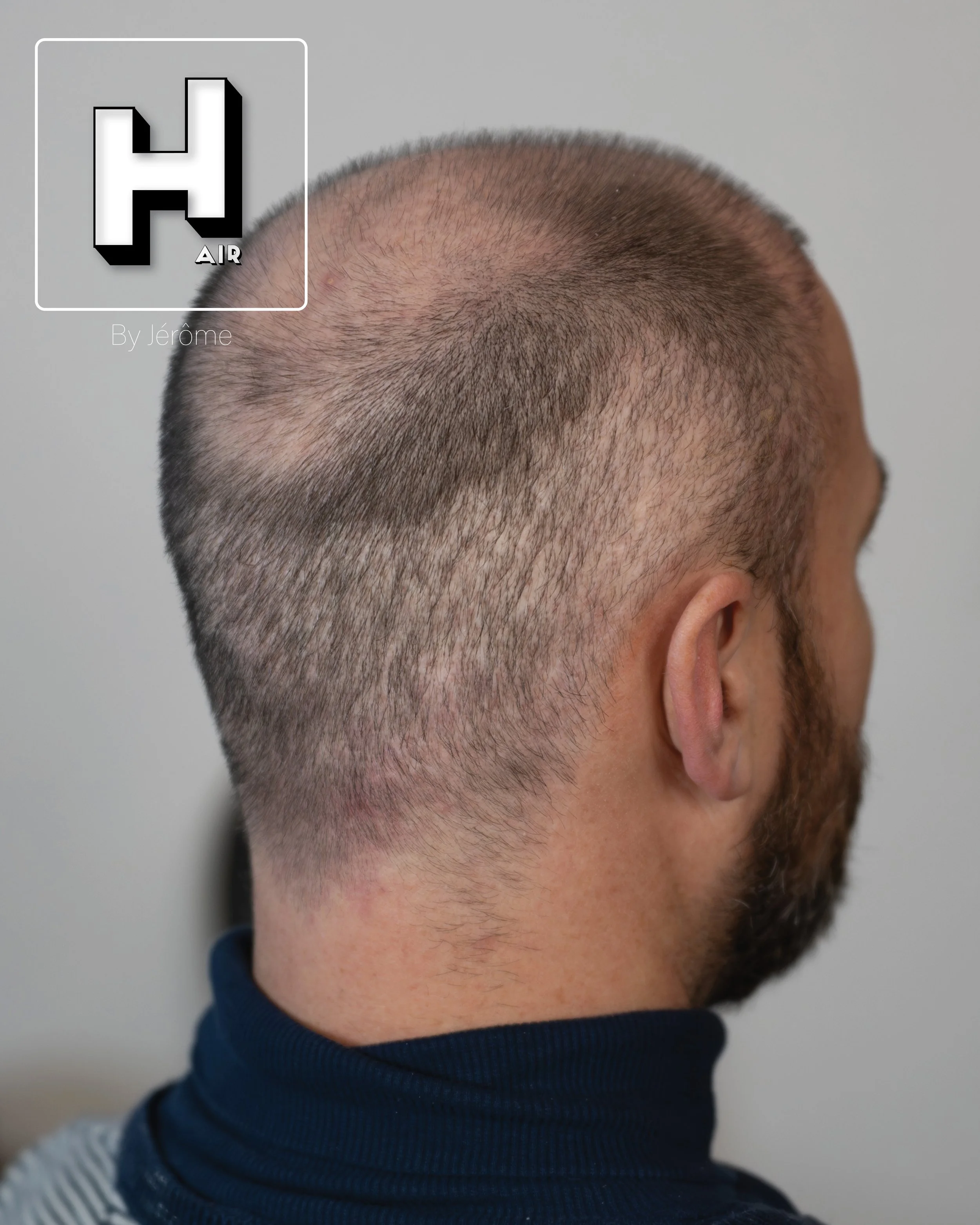 smp  effet rasé greffe cheveux turquie fue smpartistbelgium hairbyjerome22.jpg