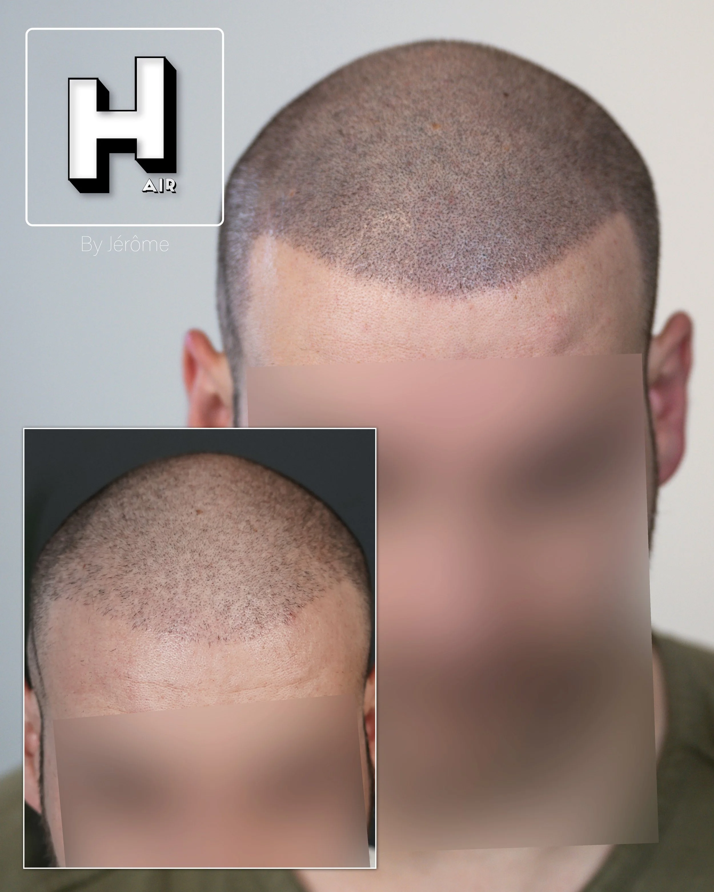 effet rasé apres greffes hair by jerome.jpg